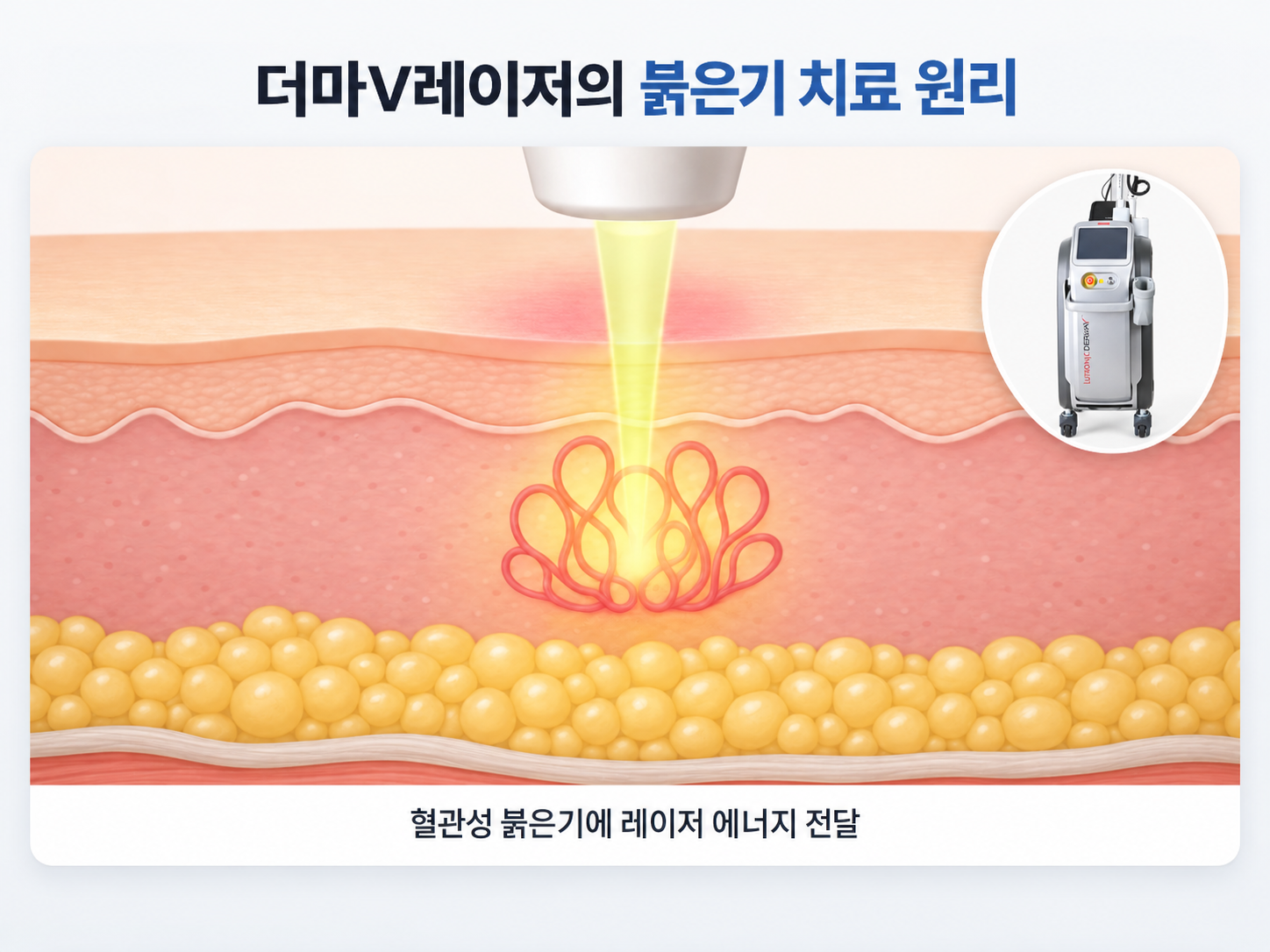 더마V레이저의 혈관성 여드름 붉은자국 치료 원리로, 피부 속 확장된 미세혈관 부위에 레이저 에너지가 전달되는 과정과 더마V 장비