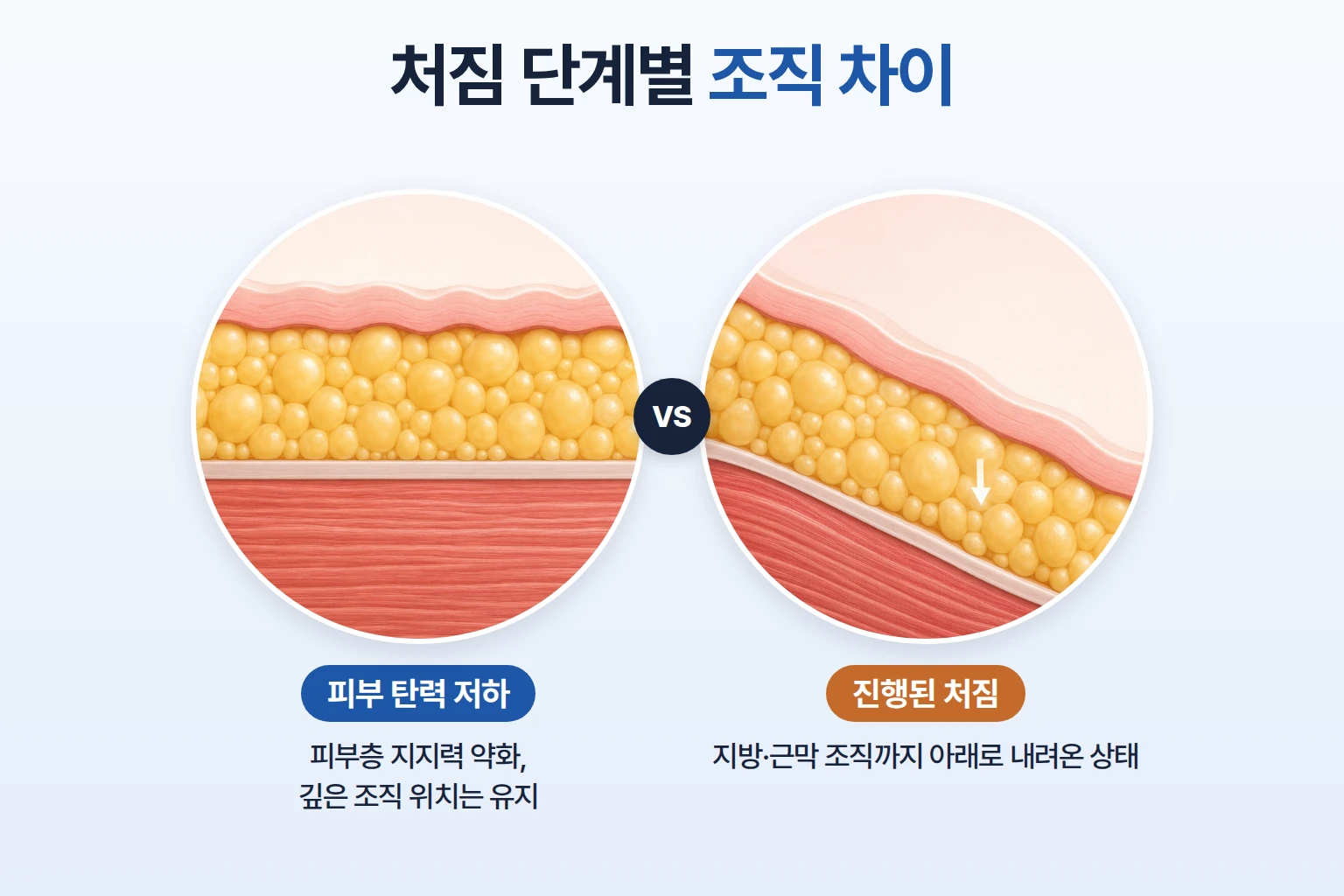 피부층만 느슨해진 탄력 저하와 지방·근막까지 내려온 처짐을 층별로 나란히 비교한 하관 단면도
