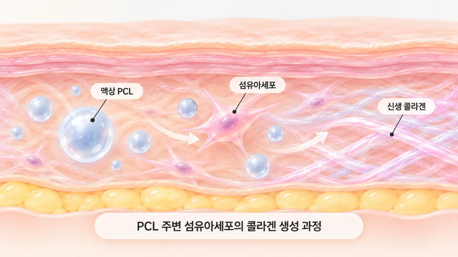 진피에 퍼진 액상 PCL 주변에서 섬유아세포가 콜라겐 섬유를 만드는 모습을 확대한 원리 일러스트