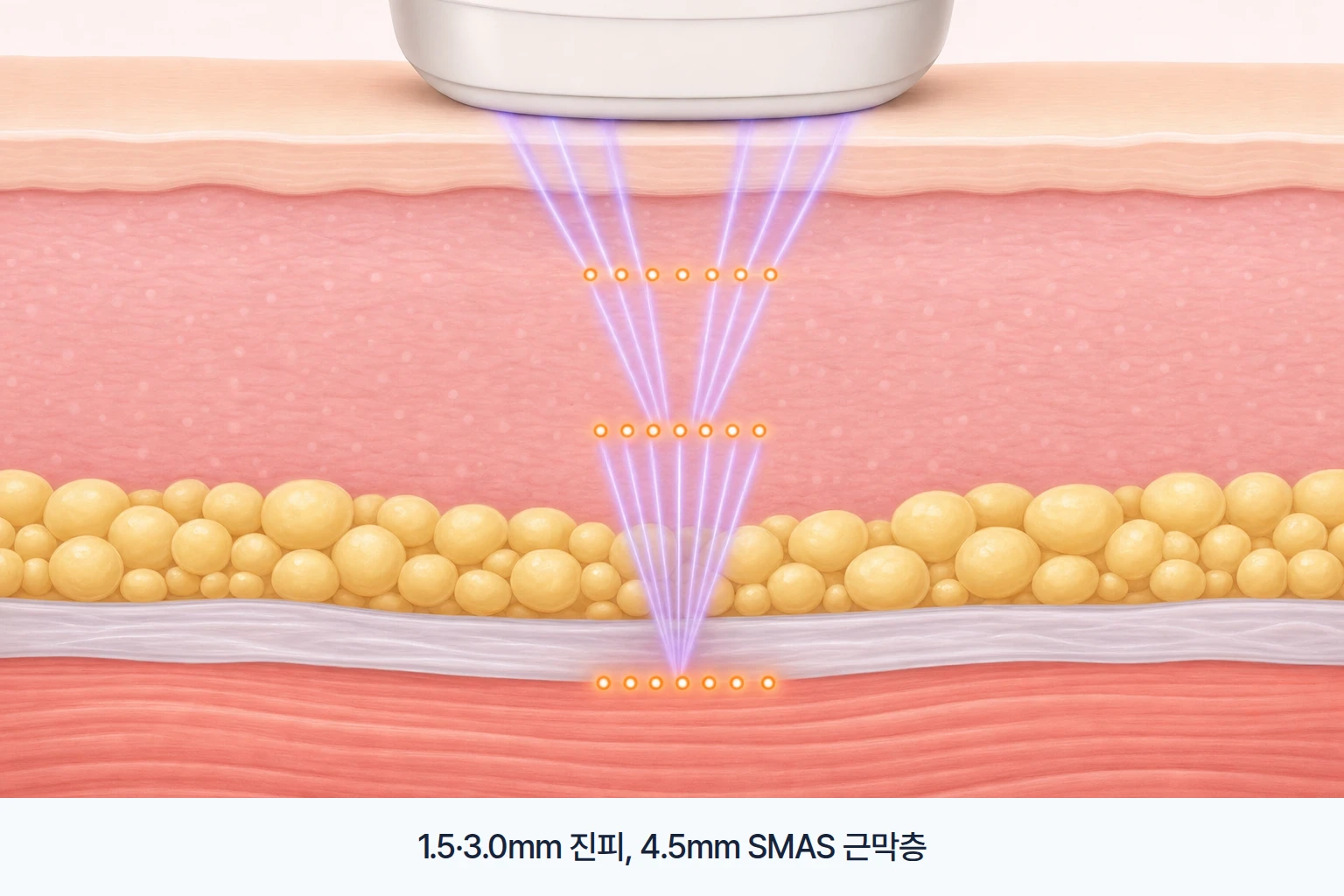 집속초음파가 표면을 지나 진피와 근막층 깊이에 점 모양 열응고점을 만드는 에너지 전달 일러스트