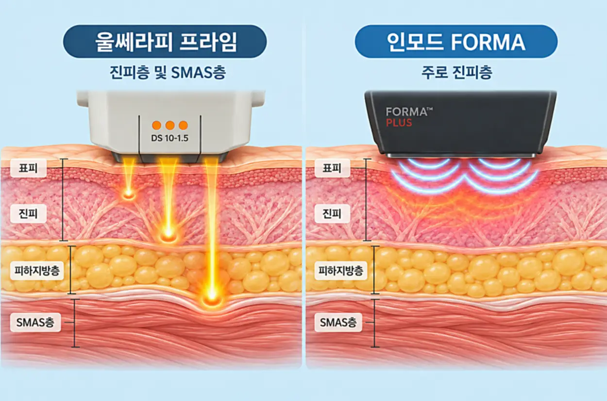 턱밑살 생기는 이유에 따른 처짐형 리프팅 시술 비교 이미지, 울쎄라피 프라임 집속초음파의 진피층·SMAS층 작용과 인모드 FORMA 고주파의 진피층 열에너지 전달 원리 단면도