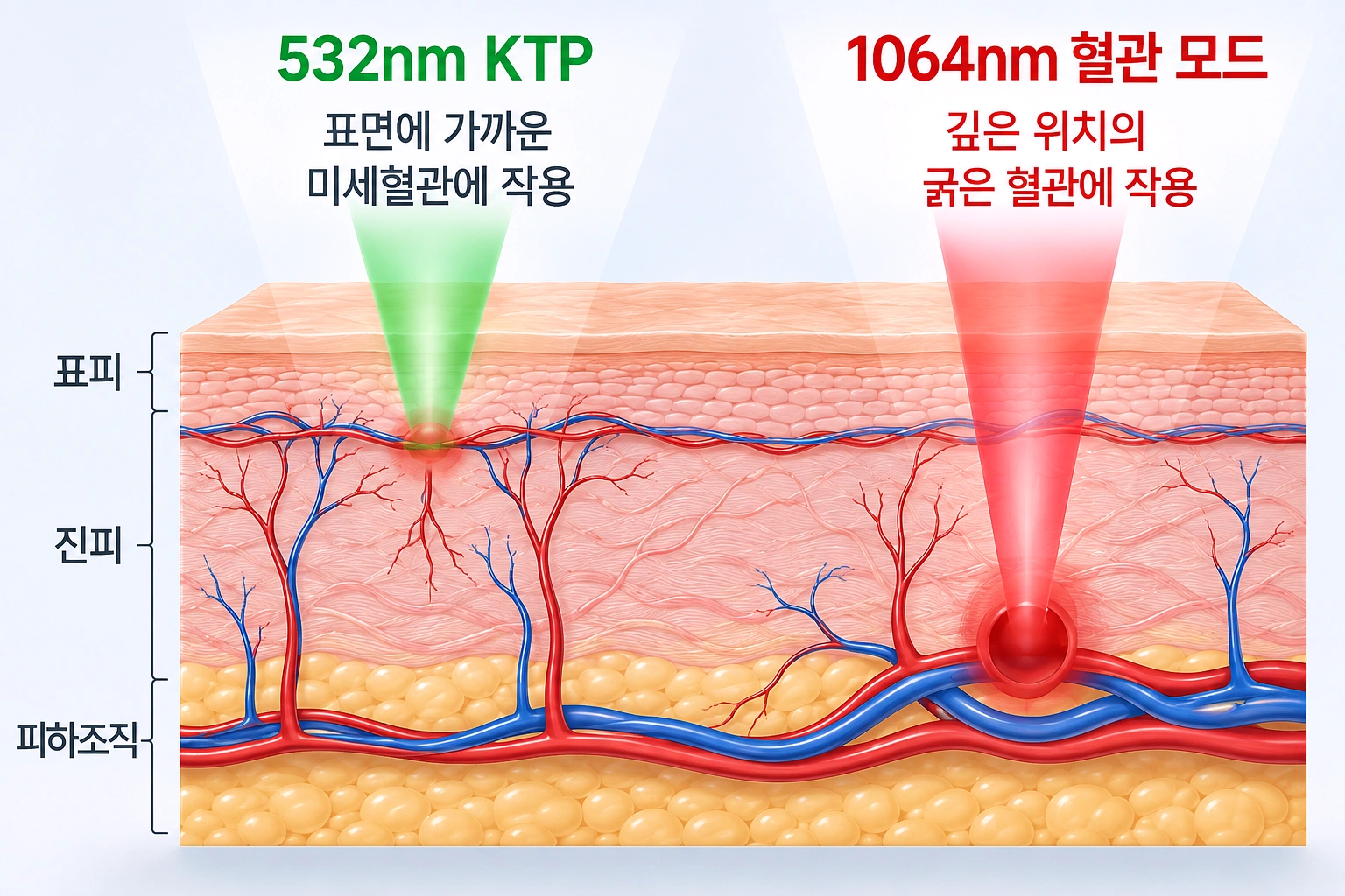 브이빔 레이저 532nm와 1064nm 파장의 혈관 깊이에 따른 작용 차이