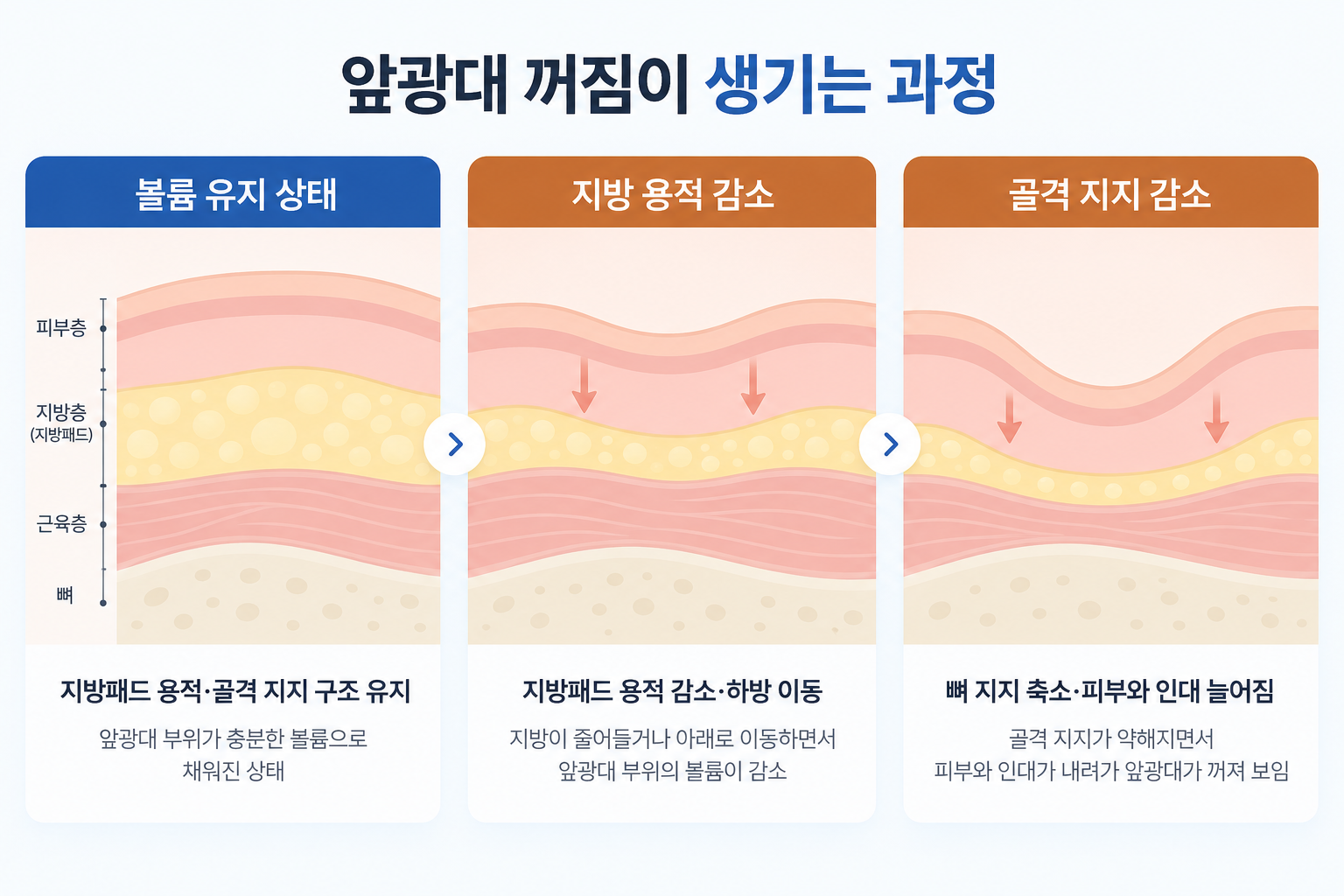 중안면 지방패드 용적 감소와 골격 지지 변화를 단계별로 비교한 앞광대 꺼짐 단면 모식도