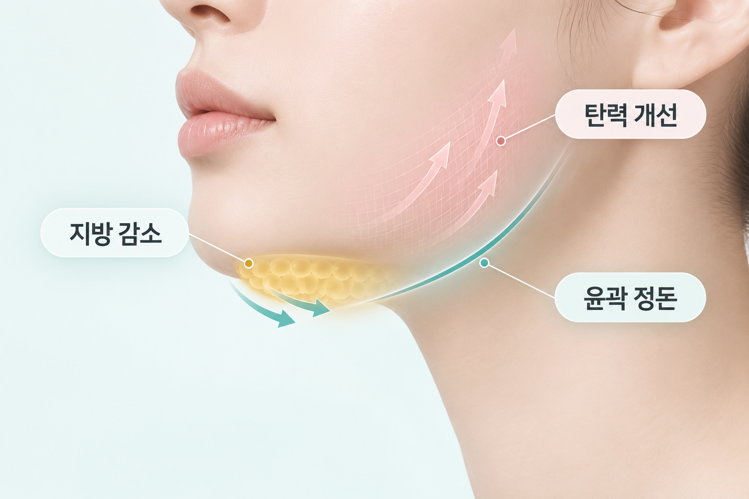 온다리프팅 효과인 턱밑 지방 감소와 피부 탄력 개선, 윤곽 정돈