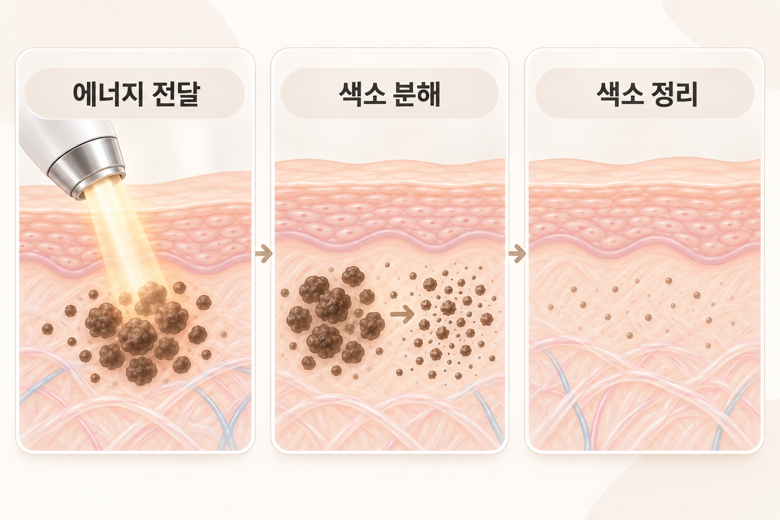 색소 레이저의 에너지 전달부터 멜라닌 분해와 색소 정리까지의 작용 과정