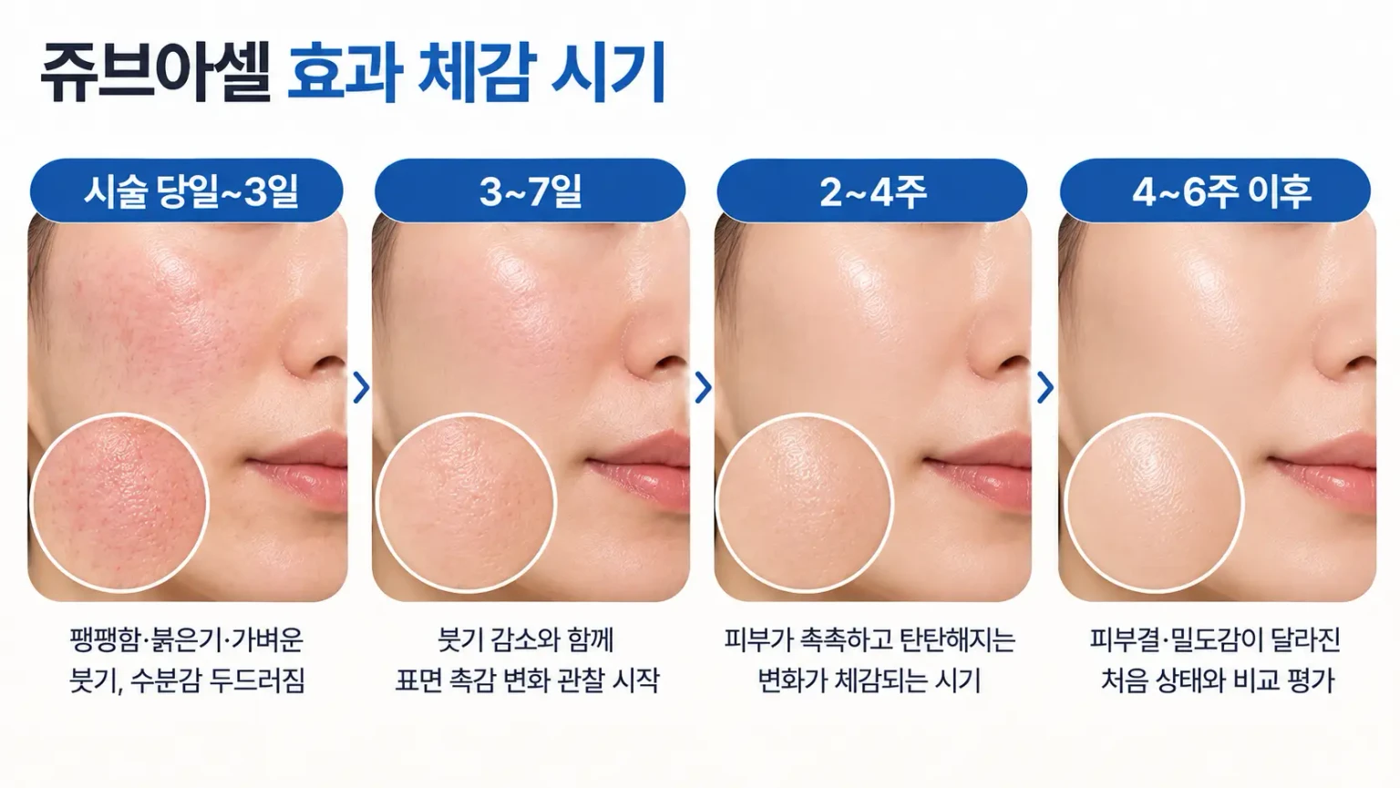 시술 당일부터 4~6주 이후까지 수분감, 붓기, 피부결 변화를 시점별로 정리한 쥬브아셀 경과 흐름