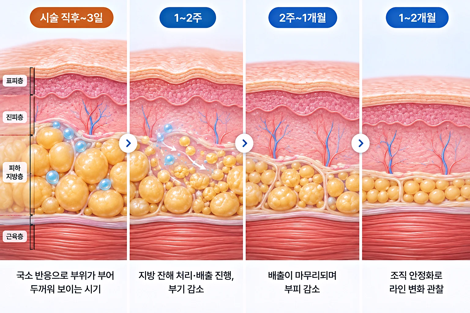 시술 직후 부기부터 1~2개월 지방층 두께 감소까지 시기별로 비교한 피부 단면 모식도