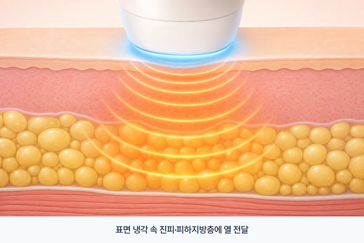 온다리프팅 2.45GHz 마이크로웨이브 에너지가 피부 표면을 냉각하면서 진피층과 피하지방층에 열을 전달하는 구조