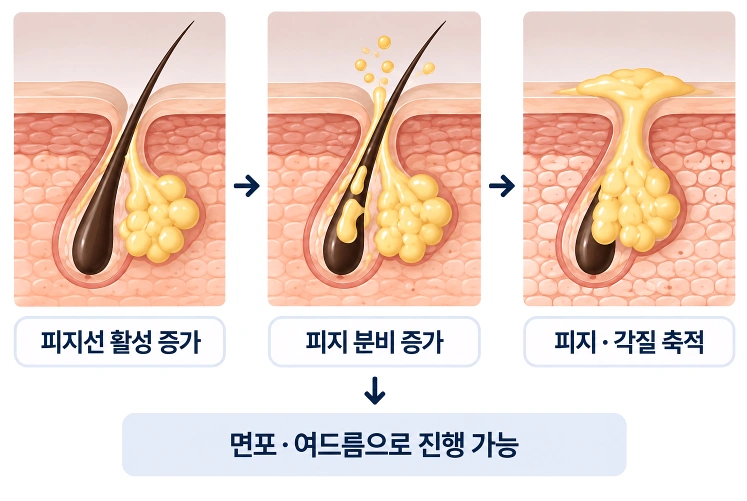피지선 활성 증가로 피지 분비가 늘고 피지와 각질이 모공에 축적돼 면포와 여드름으로 진행되는 과정을 나타낸 단면도