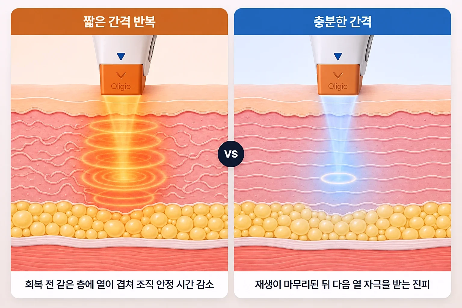 짧은 간격으로 고주파 열이 누적된 진피와 충분히 회복된 진피를 나란히 비교한 단면 일러스트