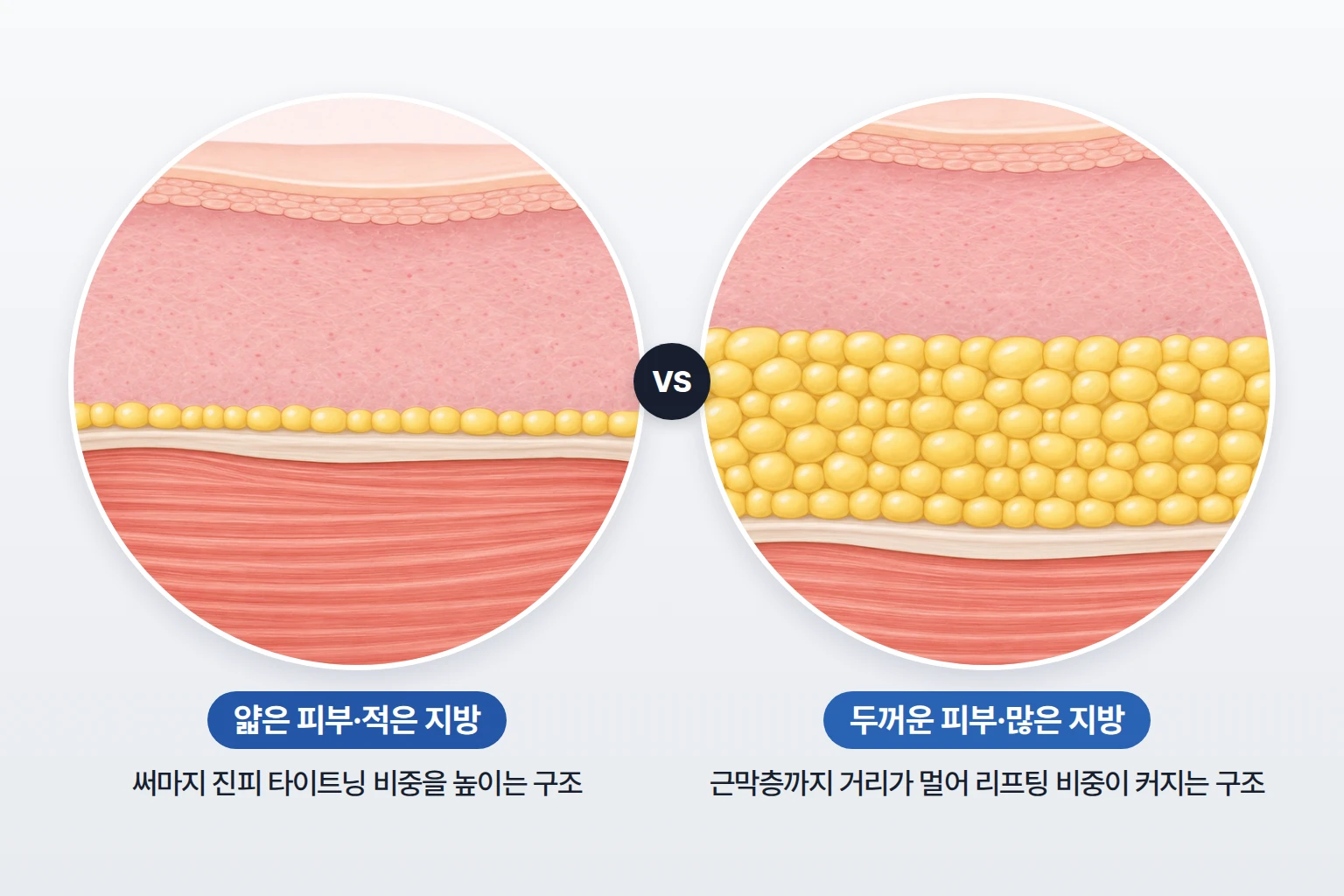 얇은 피부와 적은 지방층, 두꺼운 피부와 많은 지방층을 같은 축척으로 비교한 피부 단면도
