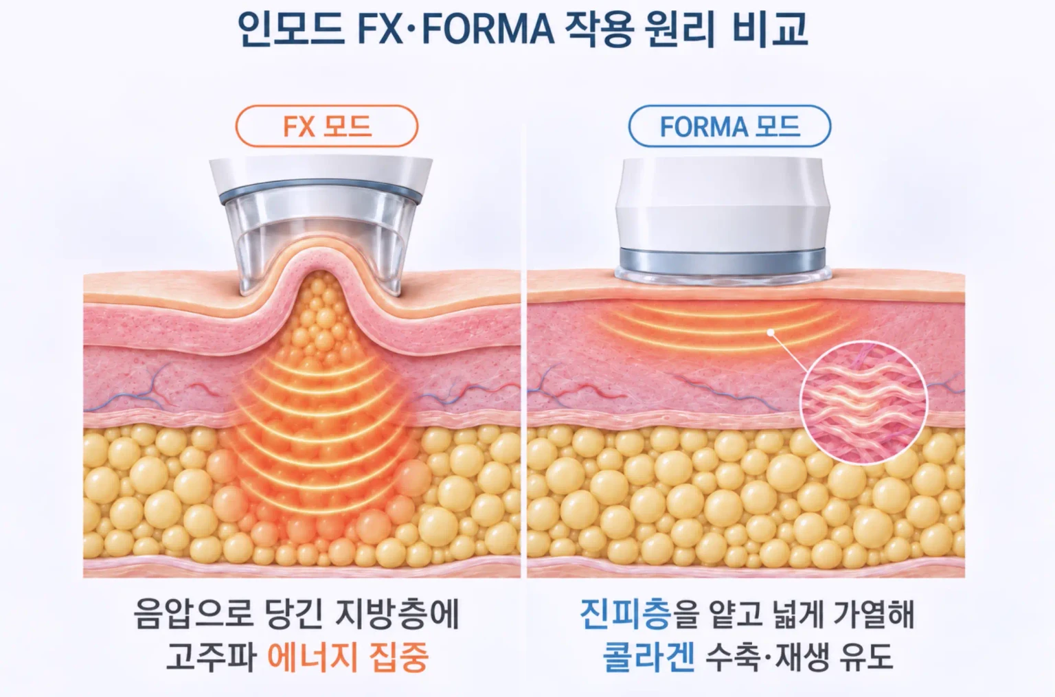 인모드 FX의 지방층 가열과 포마의 진피 가열 깊이를 비교한 턱밑 단면 모식도