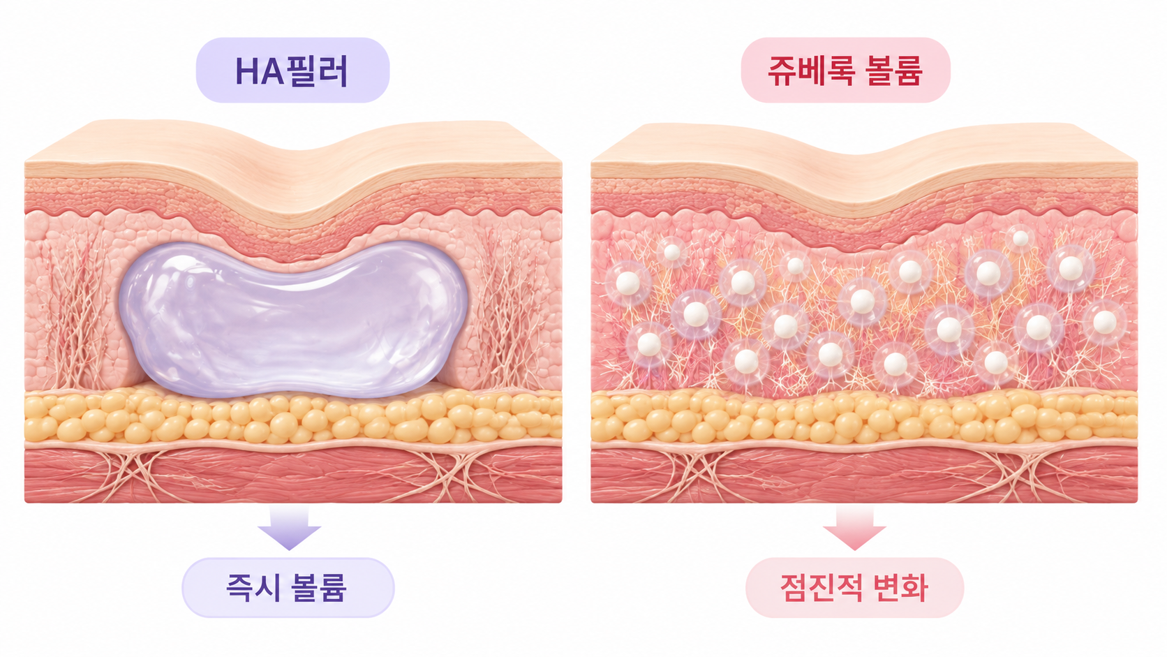 HA필러의 즉각적인 볼륨 형성과 쥬베룩 볼륨의 점진적인 콜라겐 변화 단면 비교