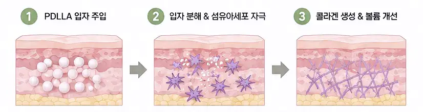 PDLLA 입자 작용에 따른 콜라겐 생성과 쥬베룩 볼륨 효과