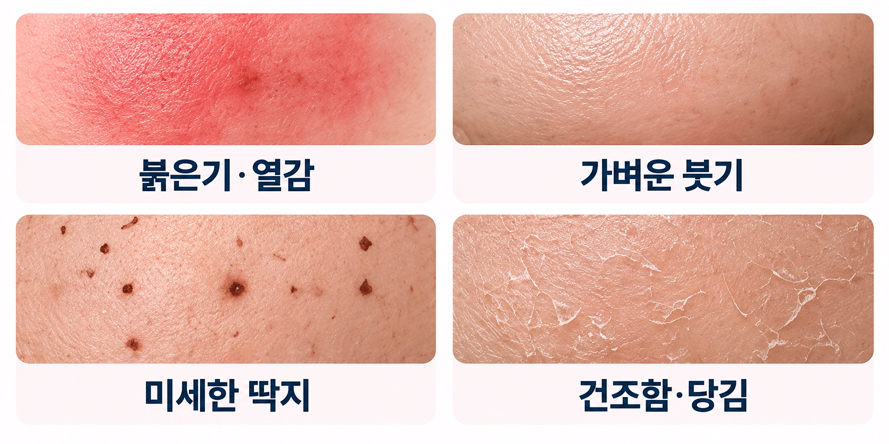 포텐자 레이저 시술 후 나타날 수 있는 일시적인 피부 반응