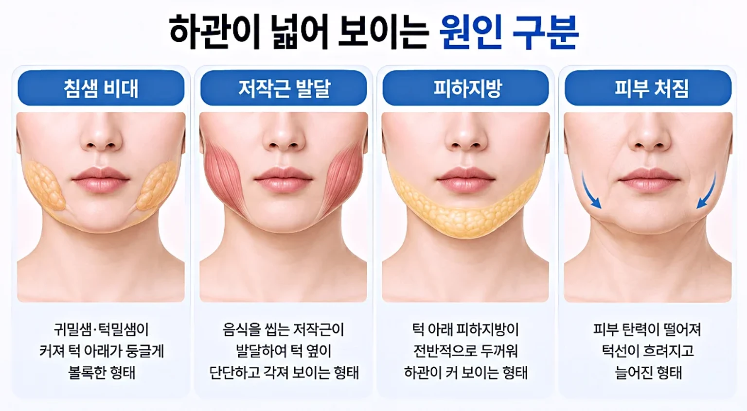 하관이 넓어 보이는 원인을 침샘 비대, 저작근, 지방, 처짐으로 구분한 카드 이미지