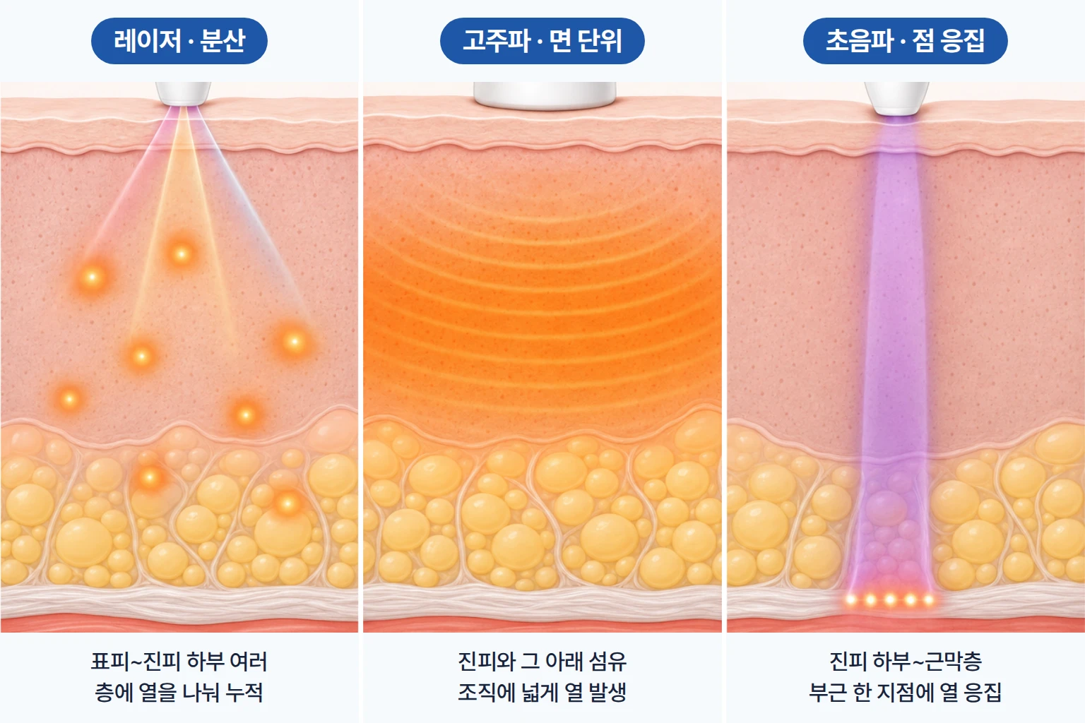 레이저, 고주파, 초음파 에너지가 피부 층에 열을 분산·면·점 형태로 모으는 방식을 비교한 단면도