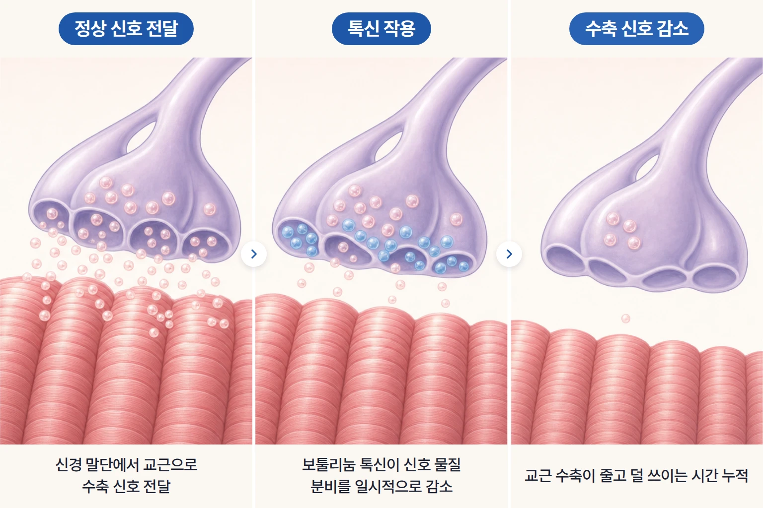 신경 말단의 신호 전달, 보툴리눔 톡신의 신호 차단, 교근 수축 감소를 단계별로 나타낸 개념도