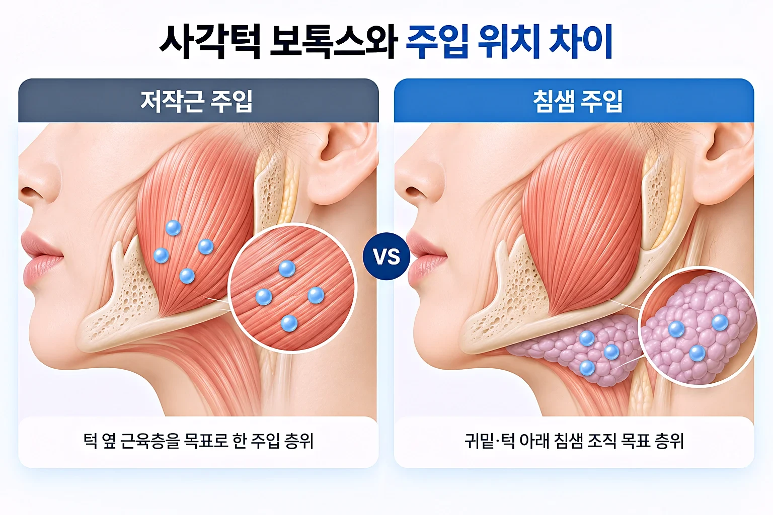 사각턱 보톡스와 침샘보톡스의 주입 층위 차이를 동일 배율로 비교한 얼굴 측면 단면도