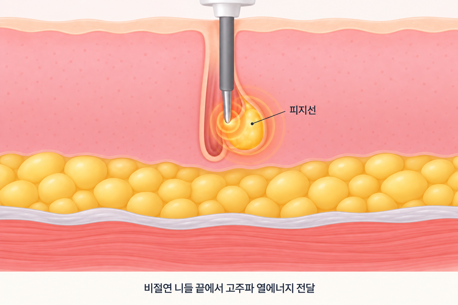아그네스 절연 마이크로니들의 비절연 끝부분에서 고주파 열에너지가 전달되어 모공과 연결된 피지선 조직에 작용하는 피부 단면 구조