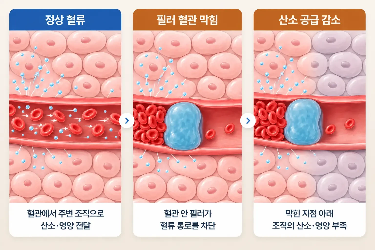 정상 혈류, 필러에 의한 혈관 막힘, 주변 조직 산소 공급 감소를 단계별로 나타낸 확대 개념도