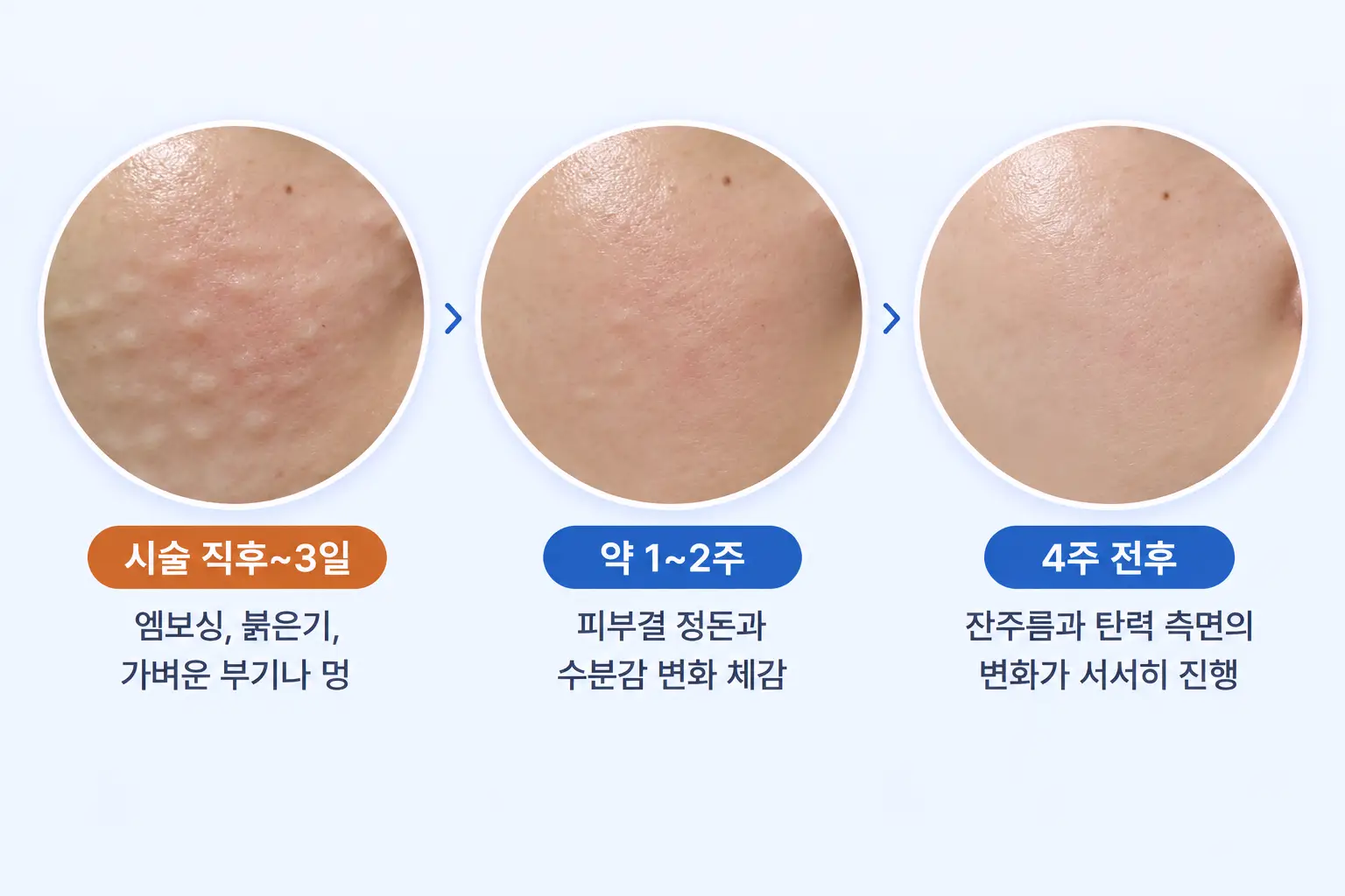 시술 직후 엠보싱과 붉은기가 사흘에 걸쳐 가라앉는 과정을 같은 배율로 비교한 피부 확대 사진