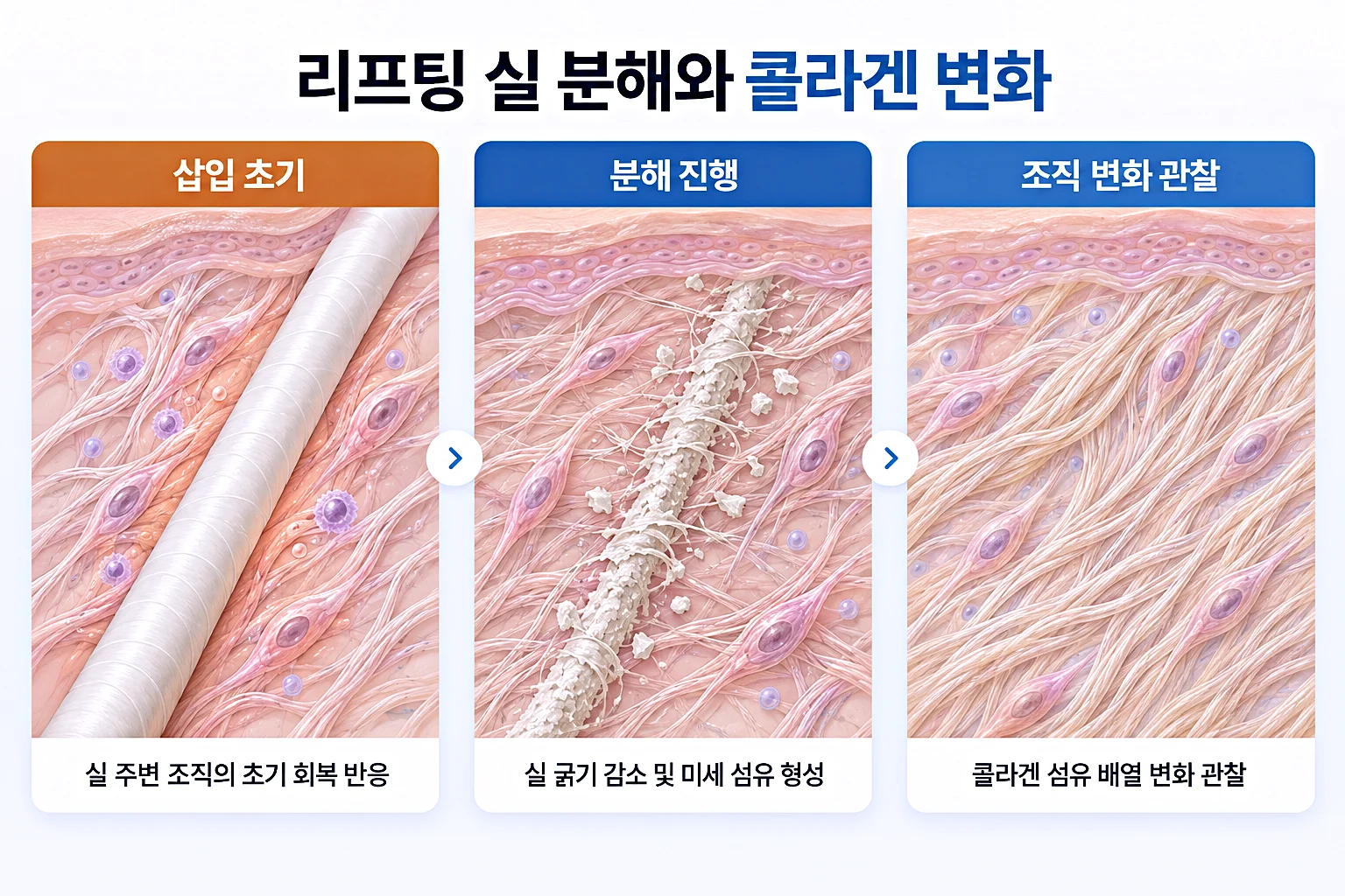 리프팅 실 분해와 콜라겐 생성 과정 - 삽입 초기부터 분해 진행, 콜라겐 섬유 배열 변화
