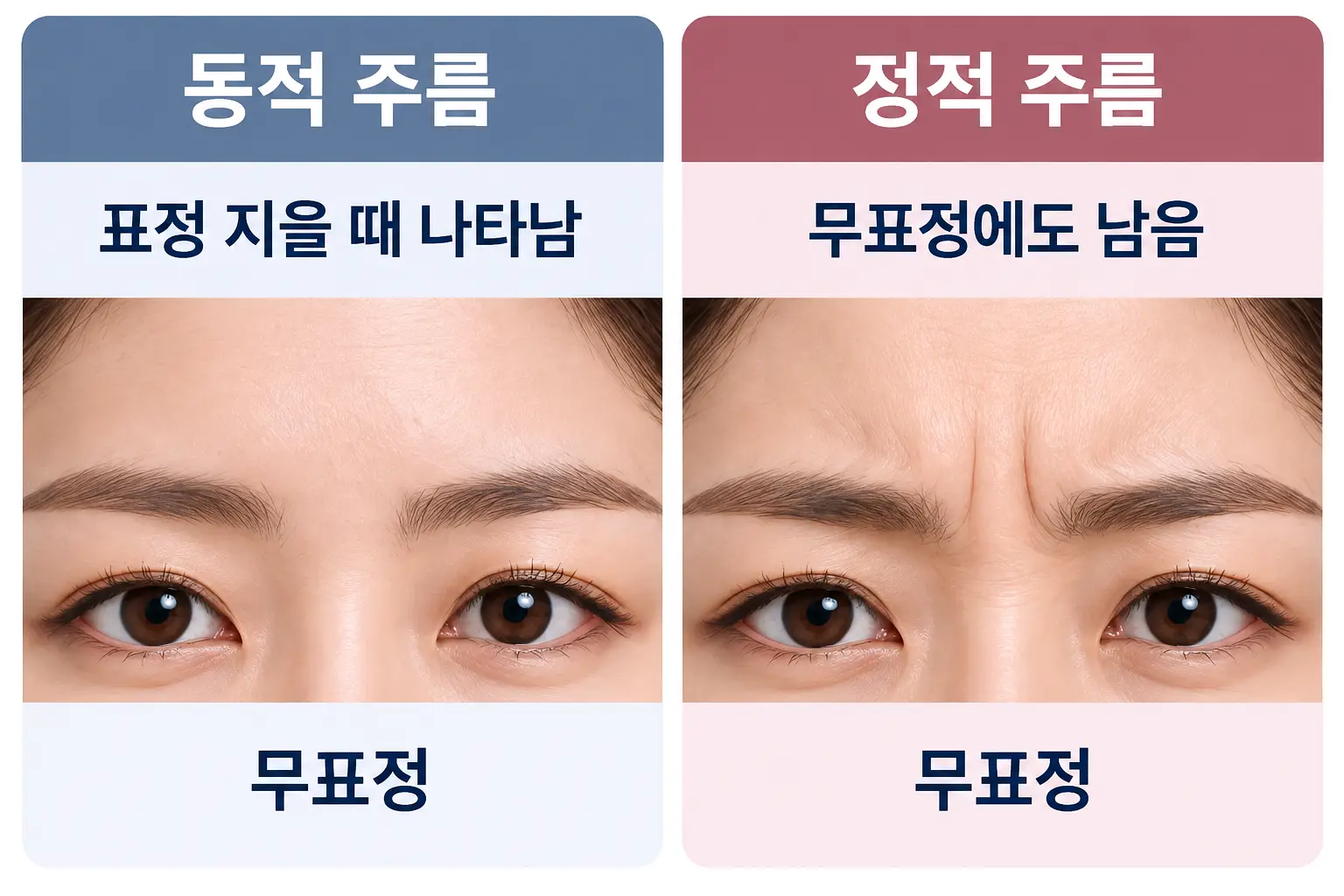 표정을 지을 때 생기는 동적 주름과 무표정에도 남는 정적 주름의 차이