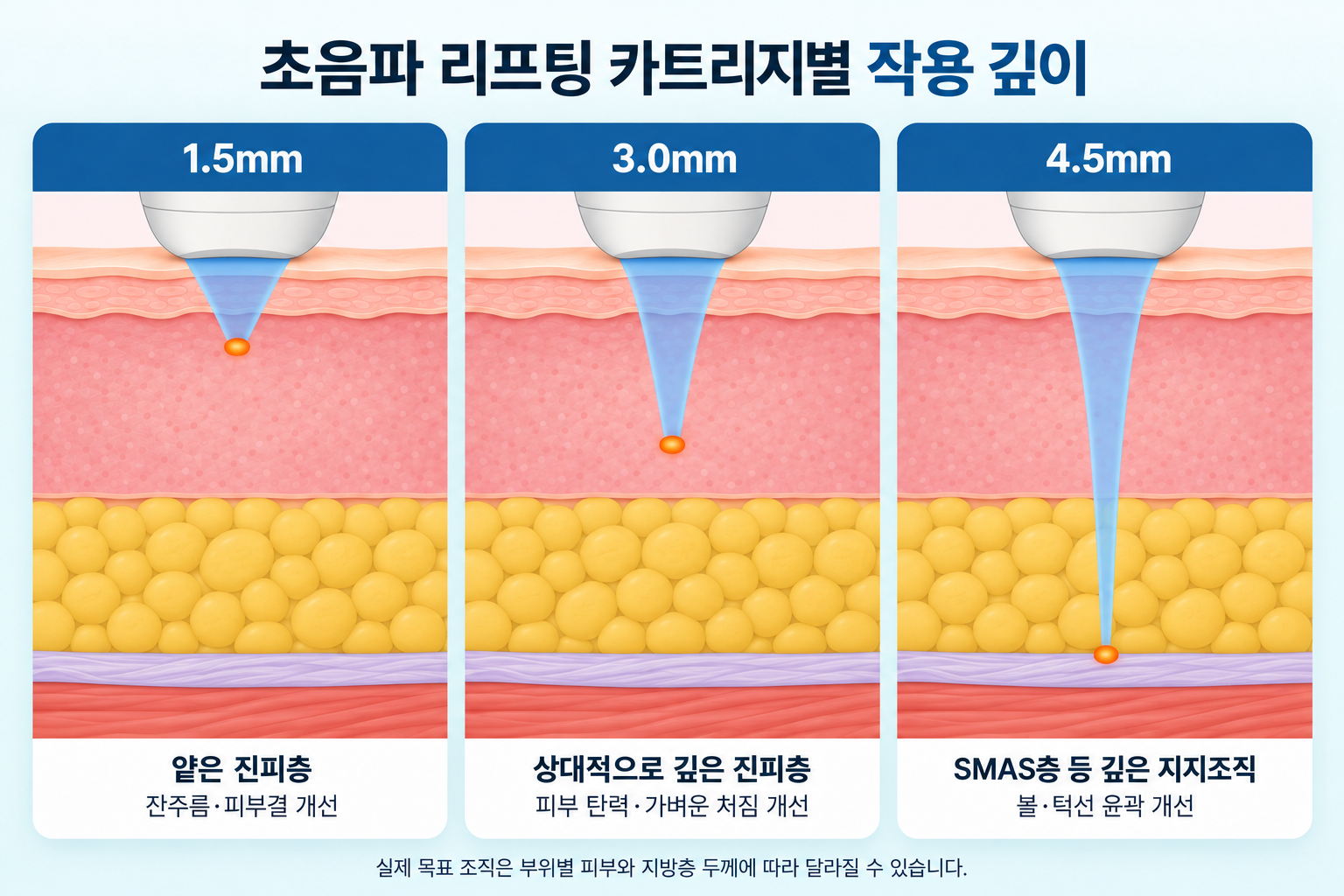 초음파 리프팅 1.5mm, 3.0mm, 4.5mm 카트리지별 피부 조직 작용 깊이와 주요 개선 부위 비교
