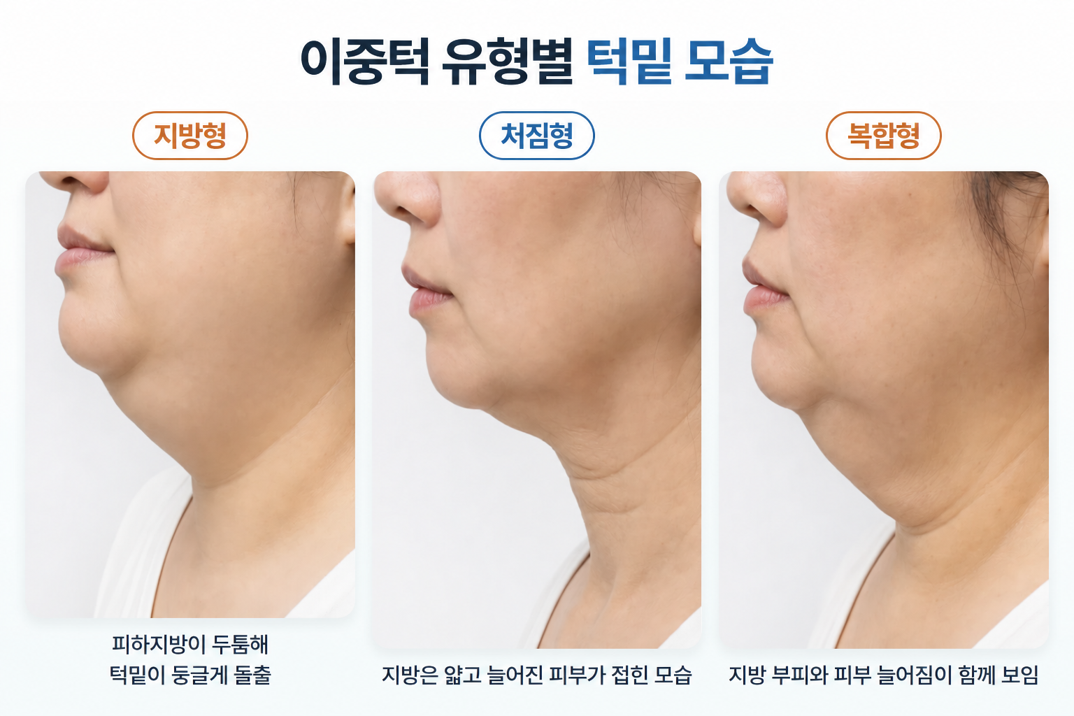 지방형 이중턱의 두꺼운 턱밑 지방, 처짐형의 늘어진 피부, 복합형의 지방 축적과 피부 처짐이 함께 나타나는 측면 차이