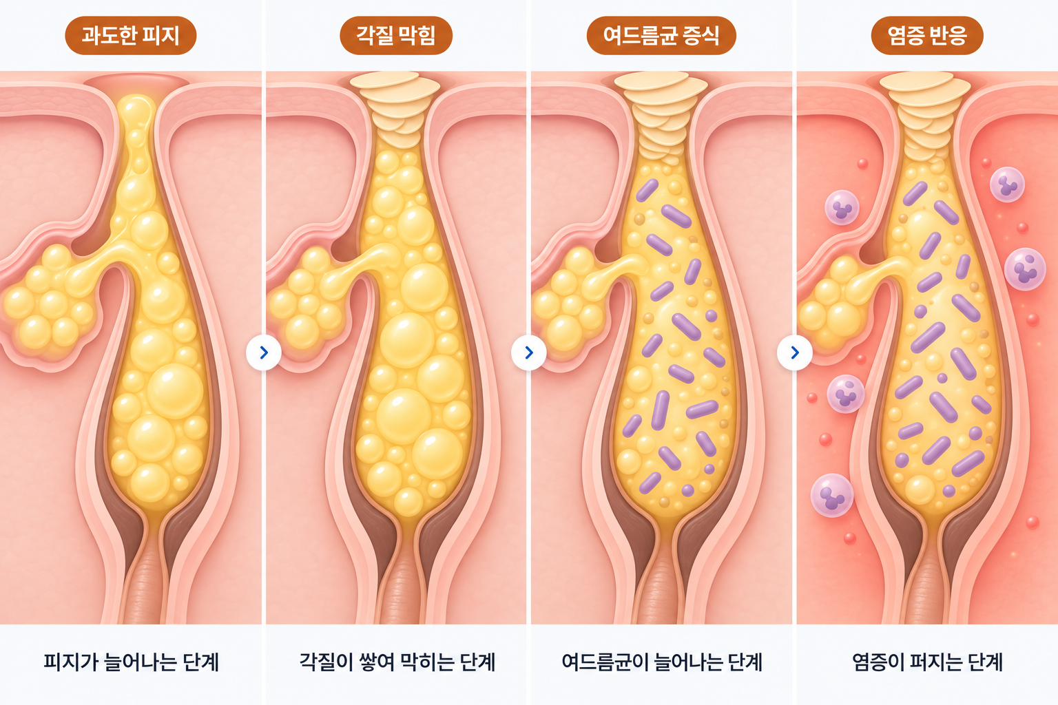 과도한 피지와 각질 막힘, 여드름균 증식, 모낭 주변 염증 반응