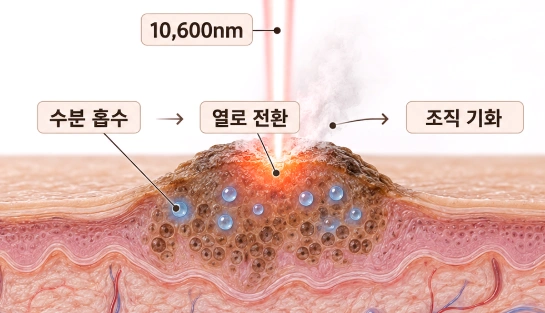 10,600nm 에너지가 조직의 수분에 흡수돼 검버섯을 기화시키는 CO2 레이저 원리