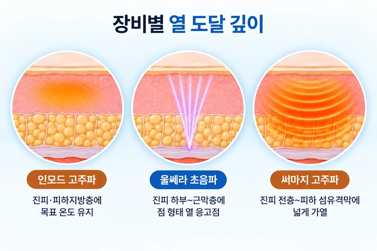 인모드 고주파, 울쎄라 집속 초음파, 써마지 단극성 고주파의 열 도달 깊이를 층별로 비교한 모식도