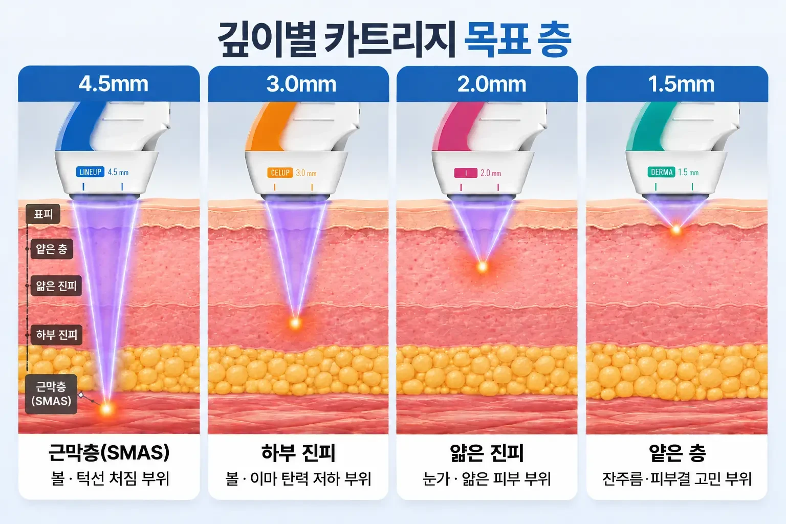 4.5mm, 3mm, 2mm, 1.5mm 카트리지의 초점 깊이를 층별로 나란히 비교한 피부 단면도