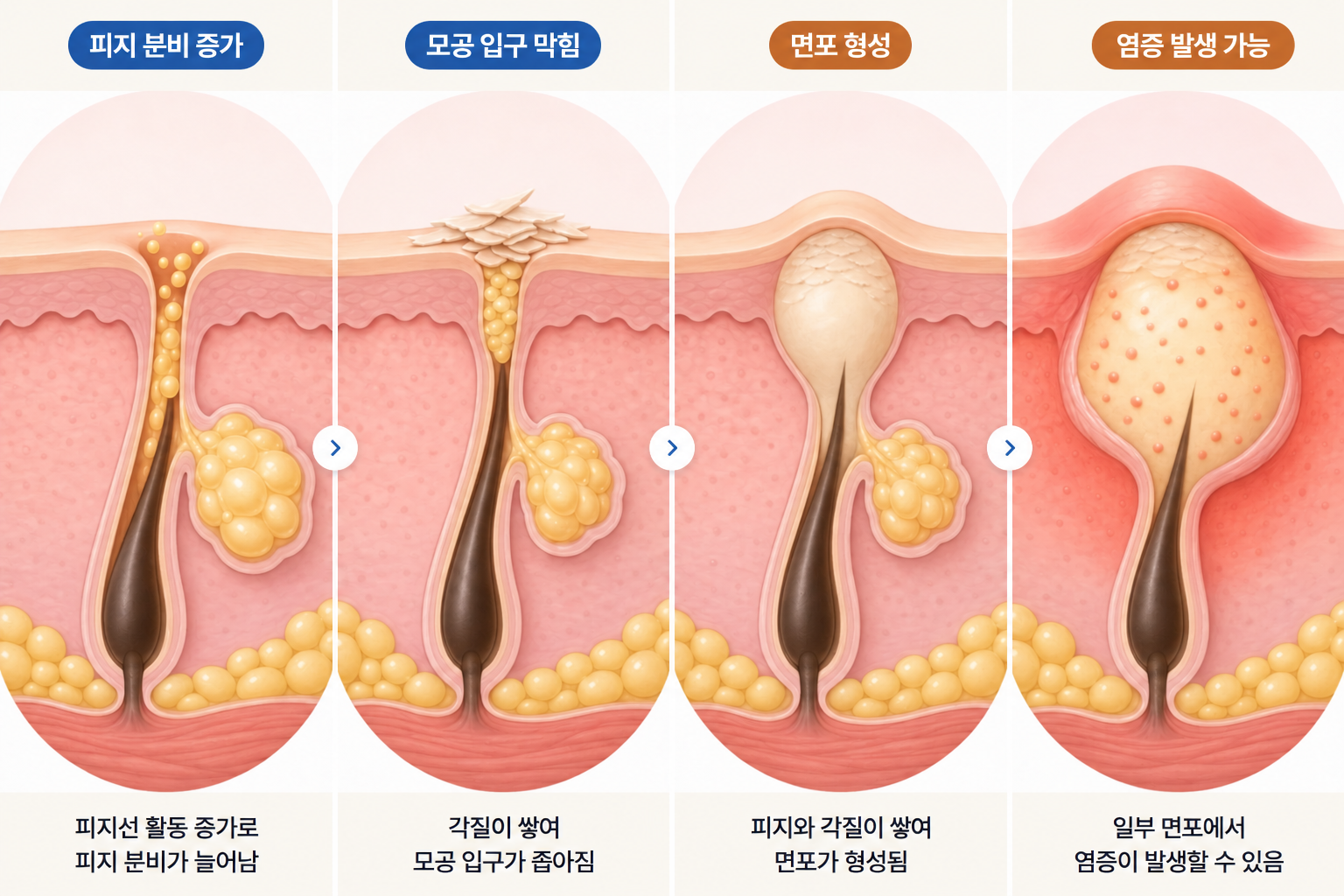 피지 분비 증가로 모공 입구에 각질이 쌓이고 면포가 형성되며 일부 모낭에서 염증성 여드름으로 진행할 수 있는 4단계 피부 단면