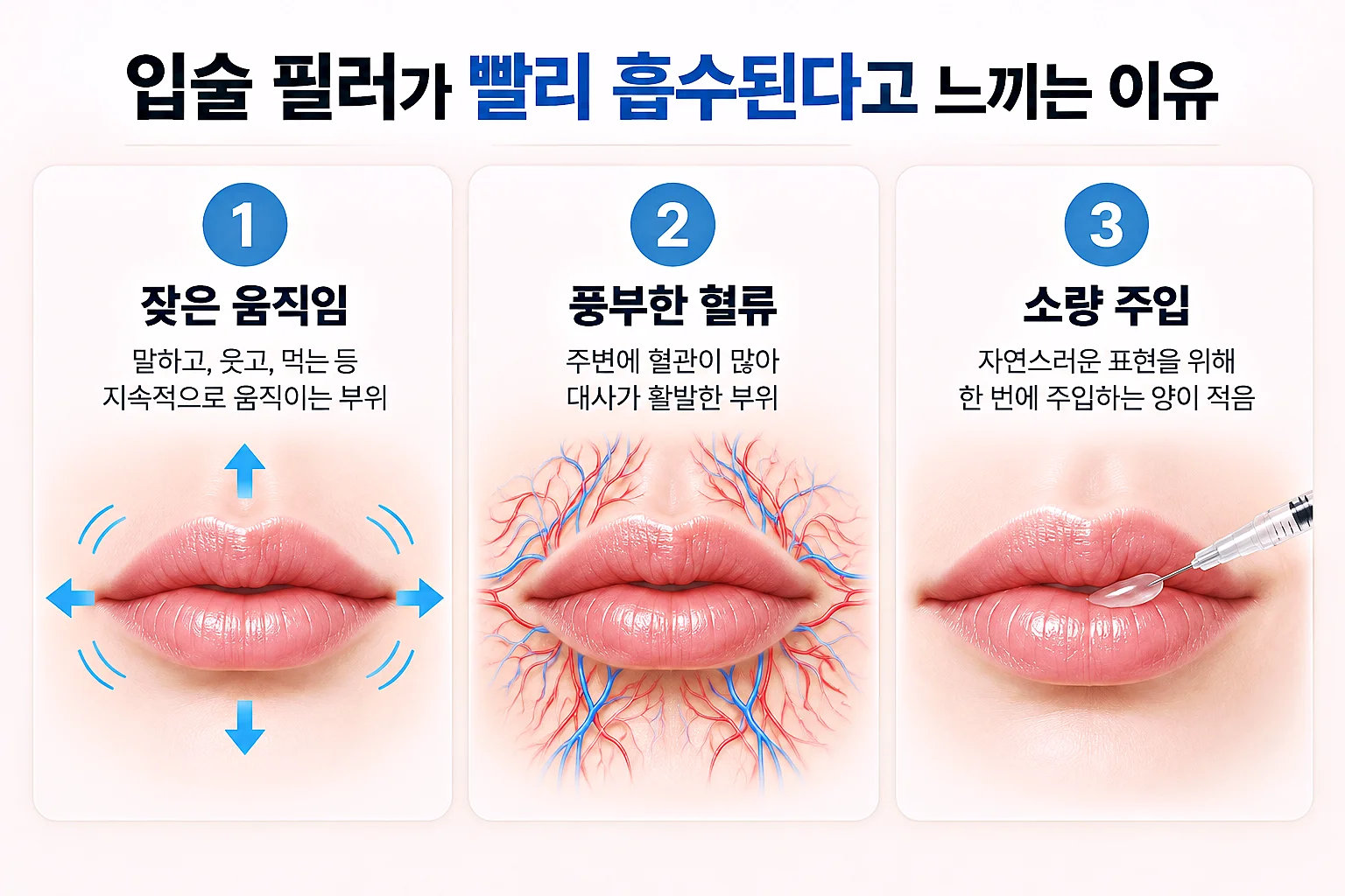 입술 필러 유지 기간에 영향을 주는 요인 - 제품 물성, 주입량과 위치, 혈류