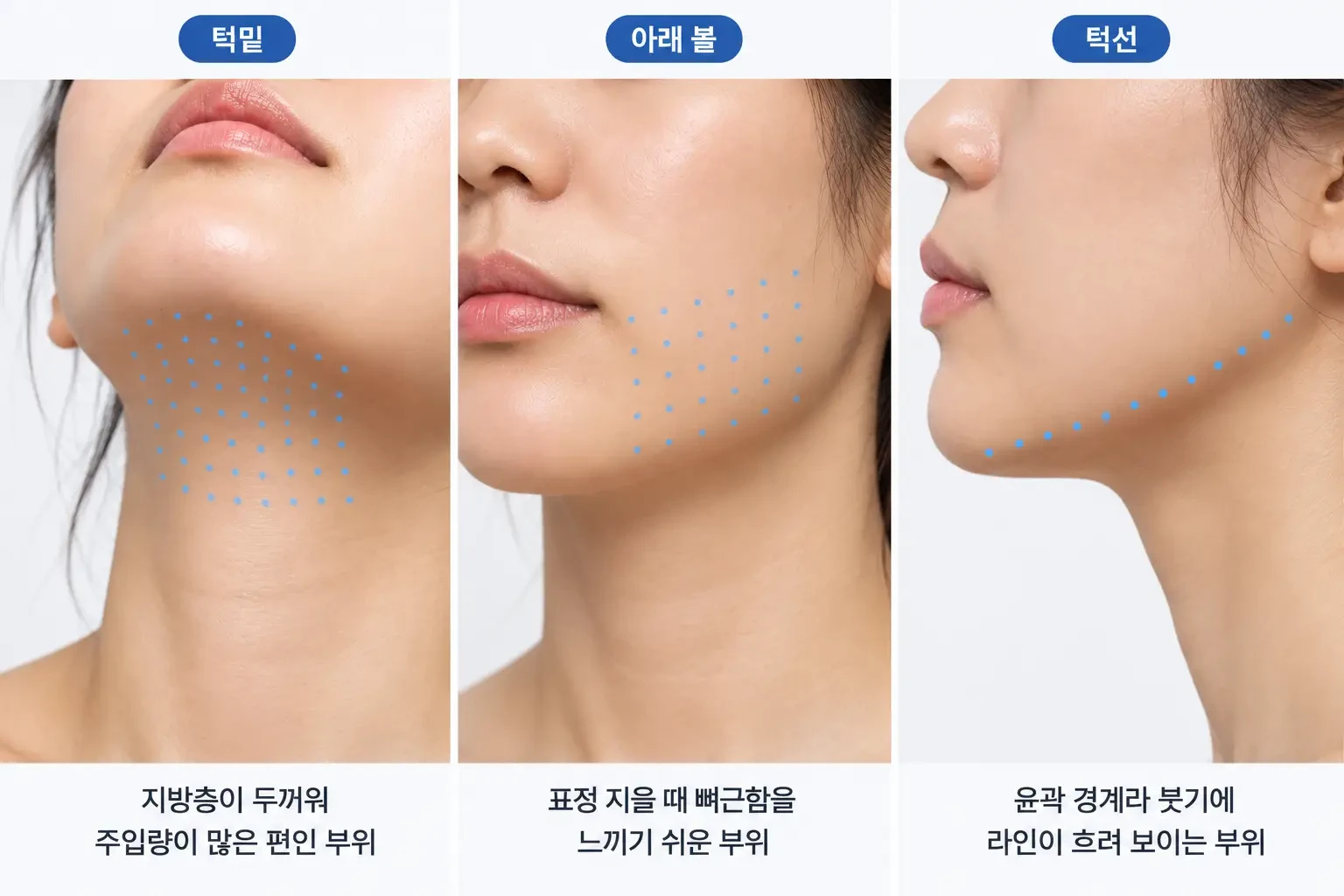 턱밑, 아래 볼, 턱선의 윤곽주사 주입 지점을 부위별로 점으로 표시한 하안면 세 컷 비교 사진