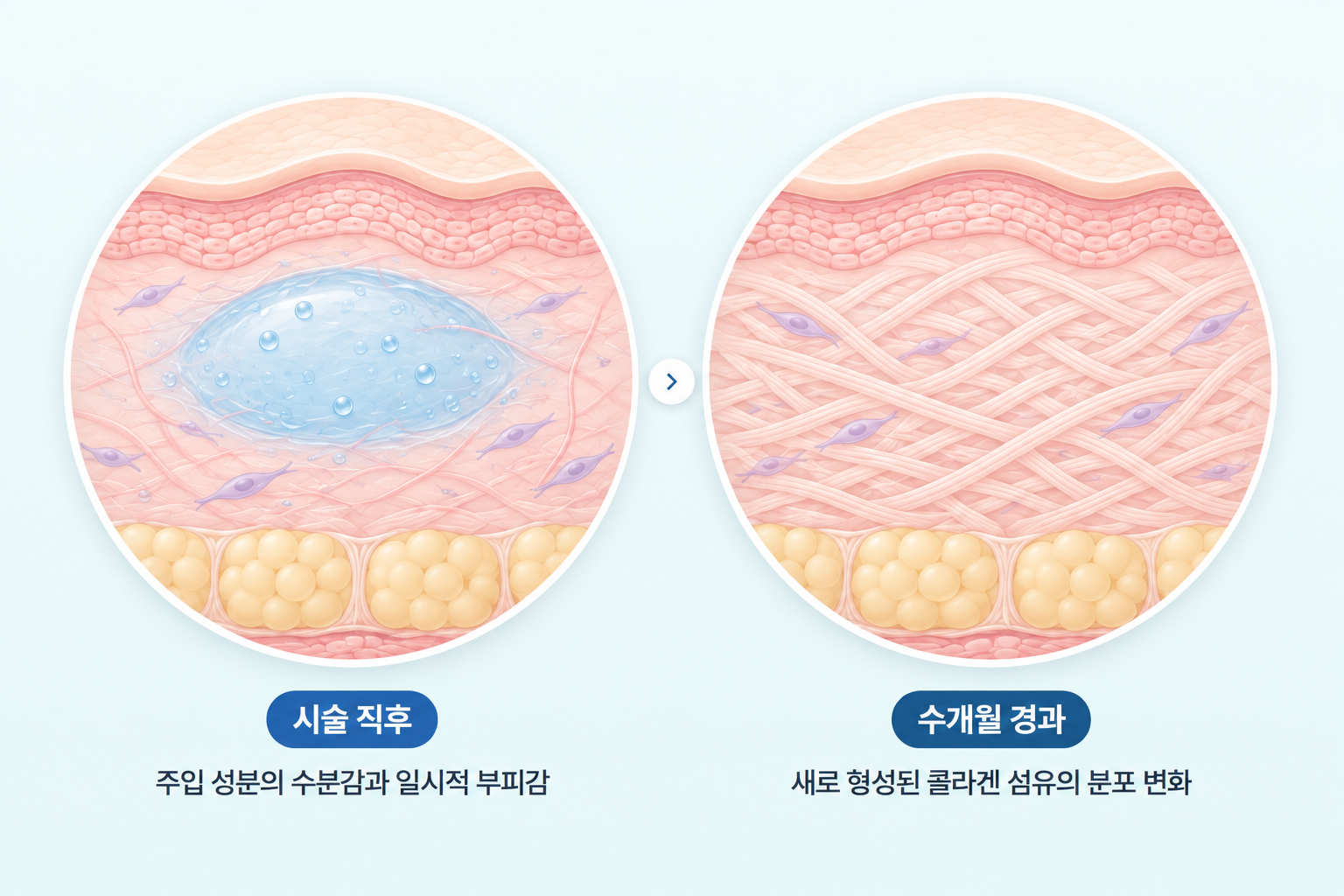 시술 직후 수분감과 일시적 부피감, 수개월 후 콜라겐 섬유 분포 변화 비교