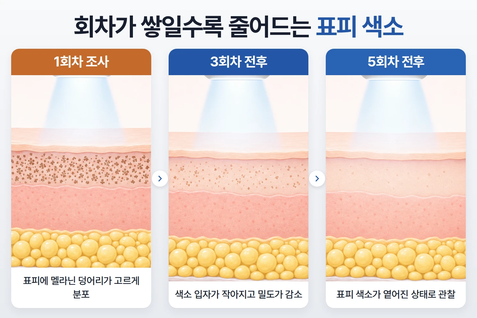낮은 에너지 반복 조사로 표피 멜라닌이 회차별로 줄어드는 과정을 비교한 피부 단면 개념도