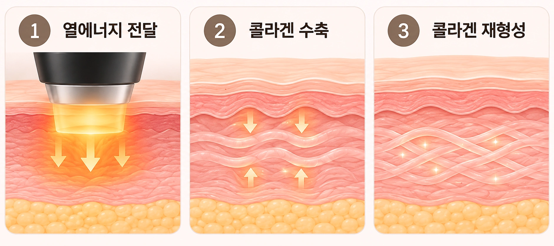 티타늄리프팅 열에너지 전달부터 콜라겐 수축과 재형성까지 3단계 원리를 나타낸 피부 단면도