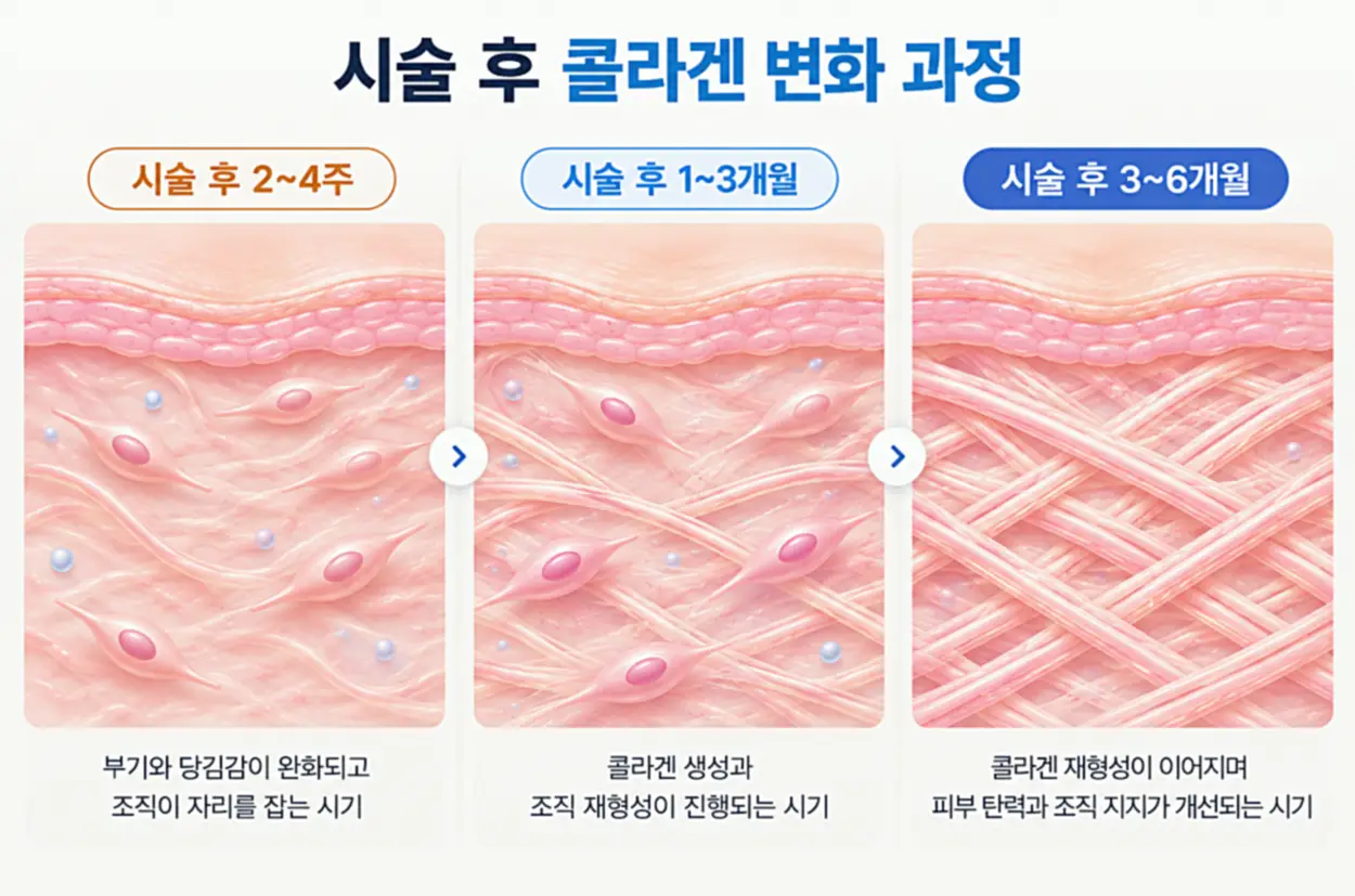 실리프팅 후 2~4주부터 3~6개월까지 콜라겐 생성과 피부 조직 변화 과정