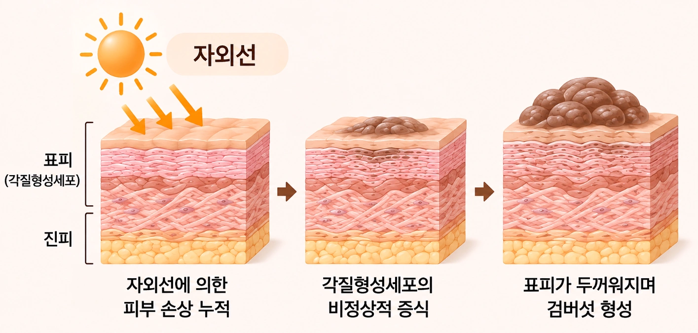자외선에 의한 피부 손상 누적과 각질형성세포 증식으로 검버섯이 형성되는 과정을 단계별로 나타낸 피부 단면 모식도