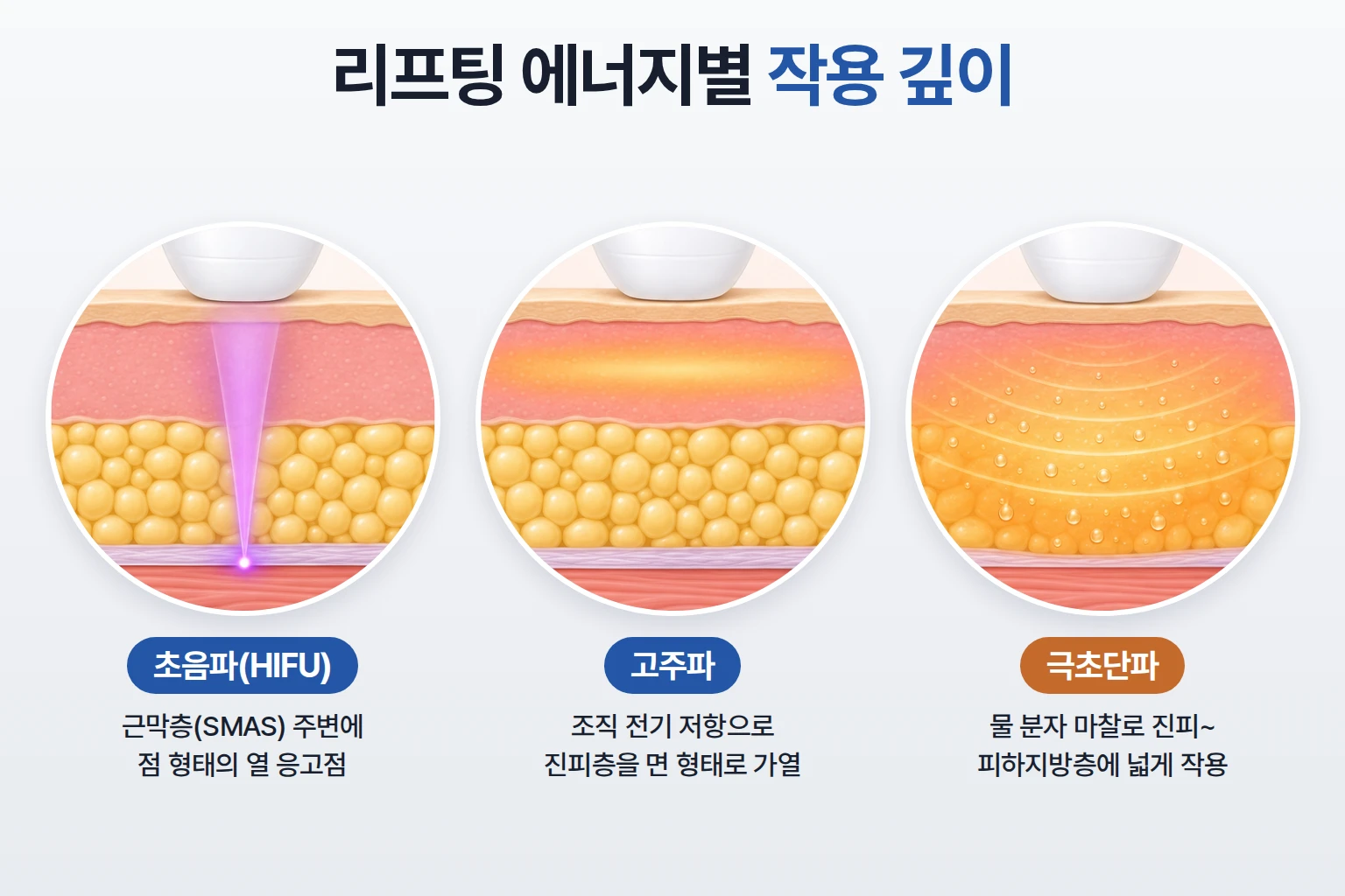 초음파, 고주파, 극초단파 에너지가 열을 만드는 피부층 깊이를 같은 단면에서 비교한 모식도