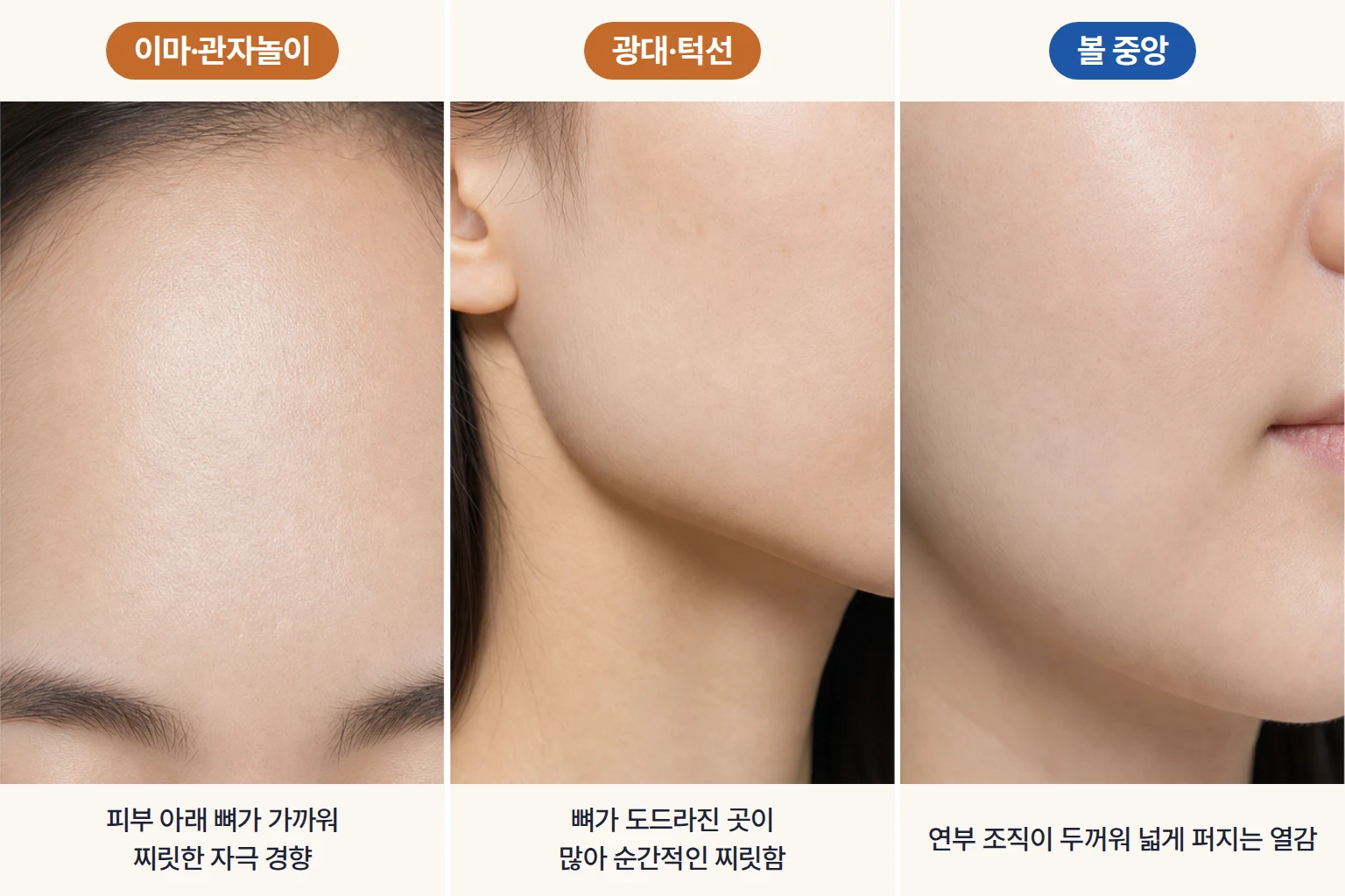 써마지 통증 차이를 비교한 이마 관자놀이 광대 턱선 볼 중앙의 조직 특징