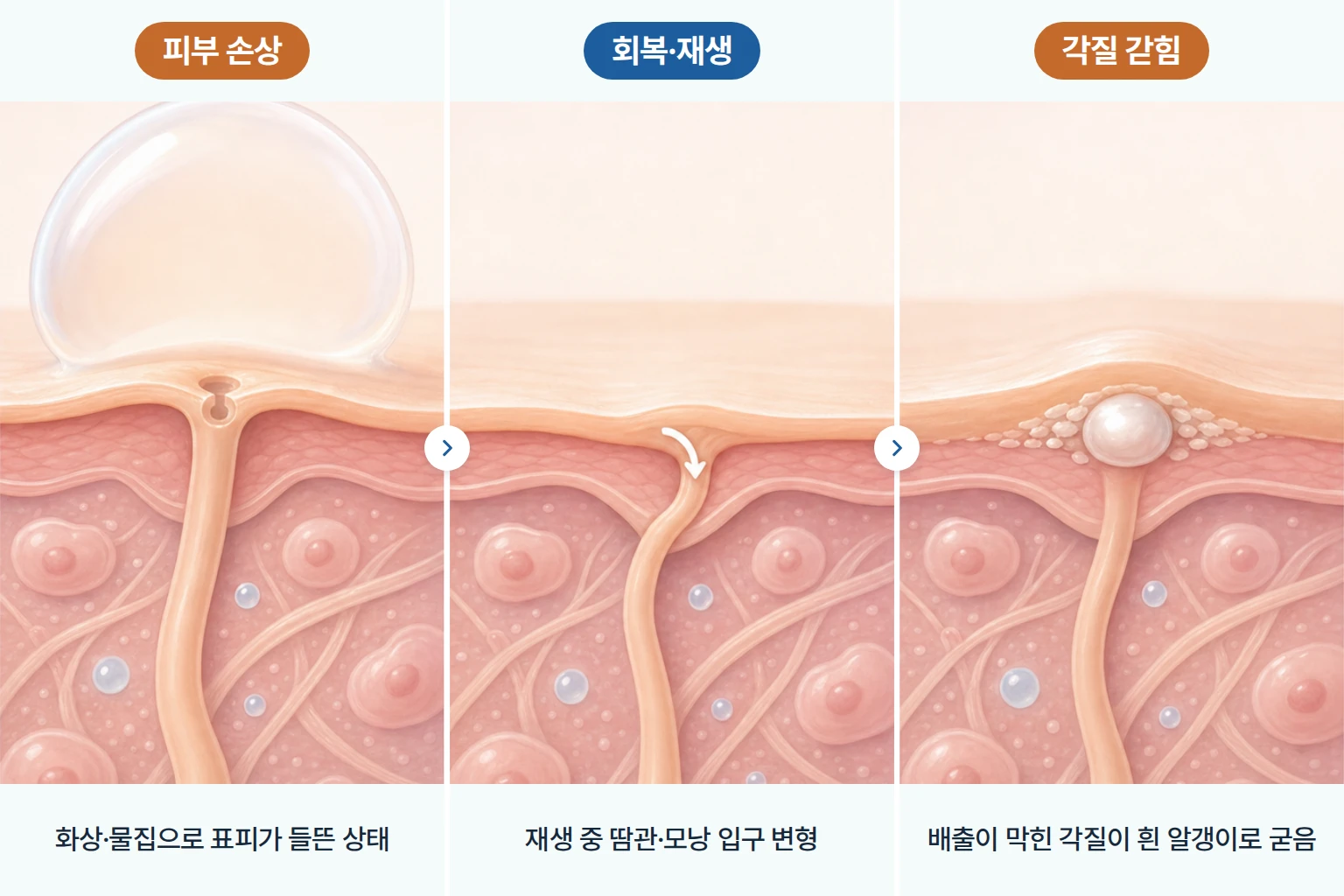 물집 손상, 표피 재생과 통로 변형, 각질 갇힘으로 이어지는 속발성 비립종 생성 과정 모식도