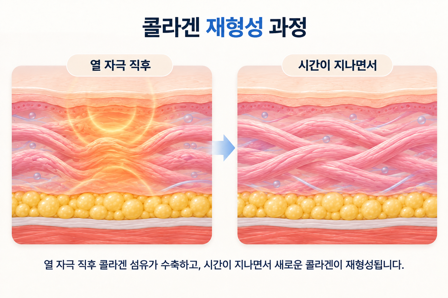 써마지 FLX 효과에 따른 고주파 열 자극 직후 콜라겐 수축과 시간 경과에 따른 콜라겐 재형성 과정