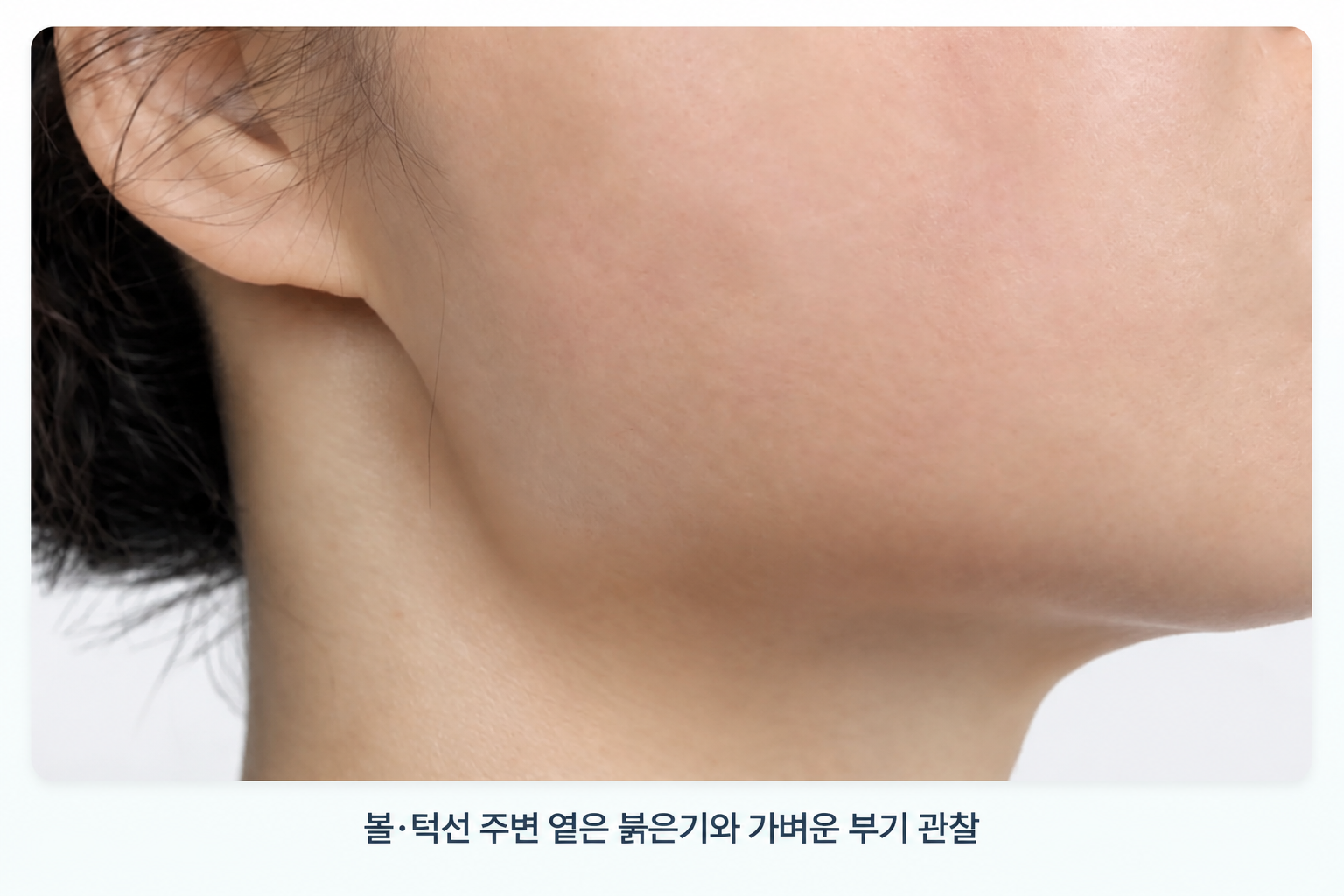 덴서티 리프팅 후 볼과 턱선 주변에 나타날 수 있는 옅은 붉은기와 가벼운 부기