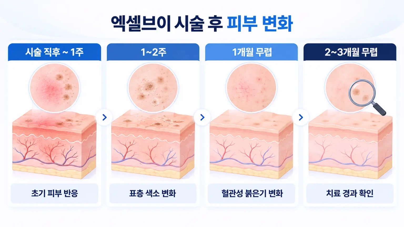 엑셀브이 레이저 시술 후 피부 변화와 회복 경과를 설명하는 피부과 의료 인포그래픽.