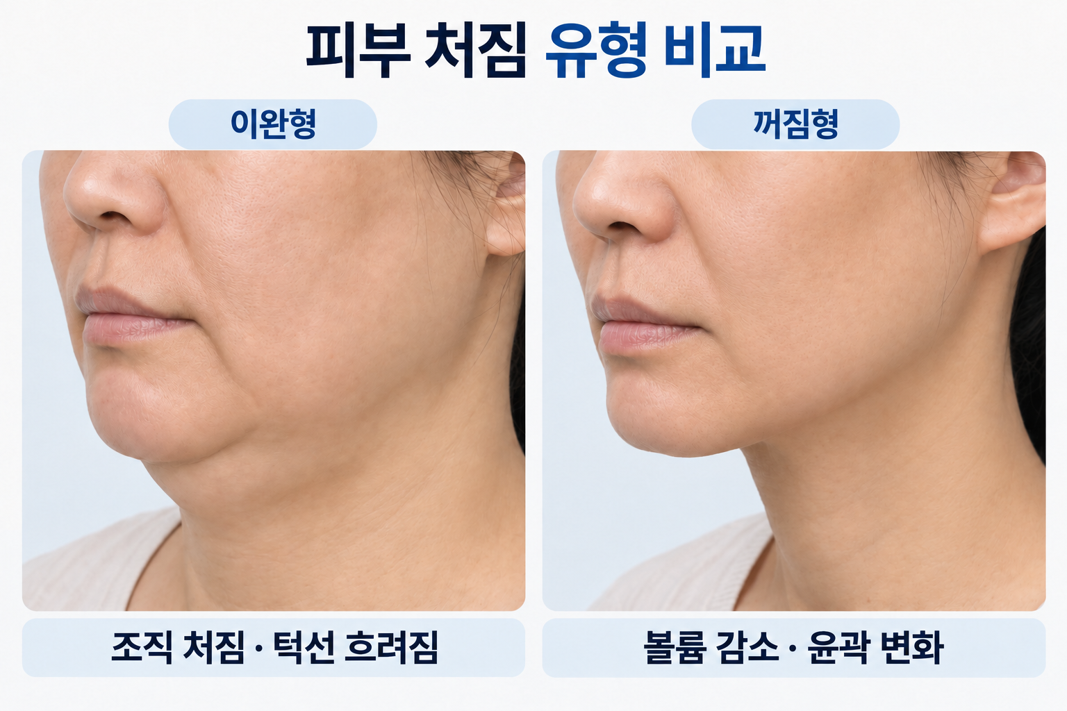 피부 처짐의 이완형과 꺼짐형에 따른 얼굴 윤곽 및 볼륨 차이를 비교한 이미지