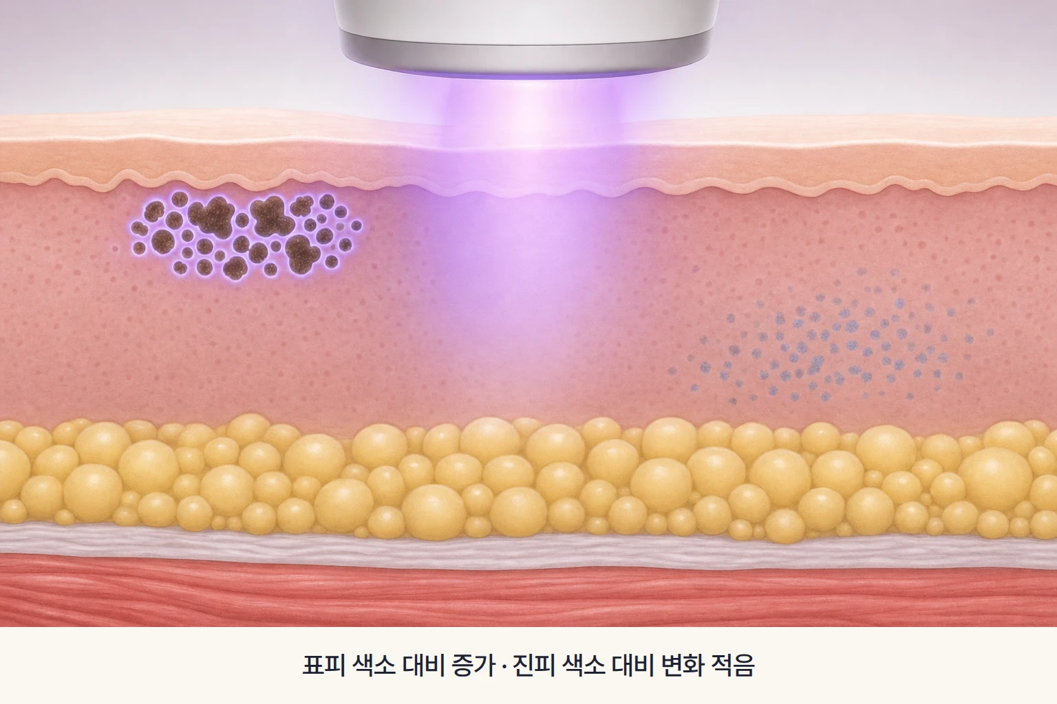 우드등 자외선 빛 아래 표피 색소의 대비 증가와 진피 색소의 적은 변화를 나타낸 단면 일러스트